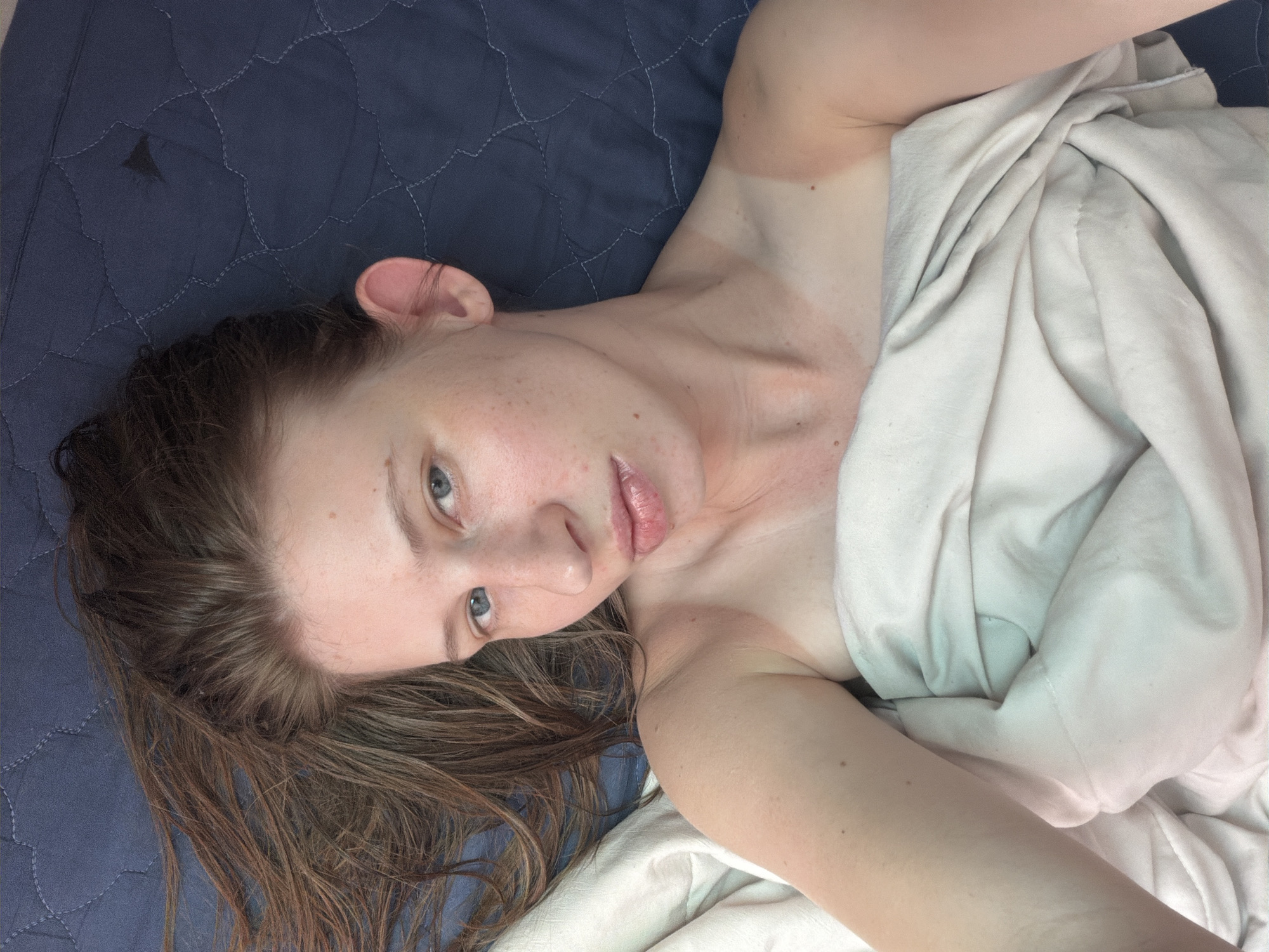 A young adult with long brown hair and blue eyes lies on a dark blue quilted surface, partially covered by a light-colored blanket. The individual is looking upwards towards the camera, with their face angled slightly to the left. There is noticeable sunburn on the shoulders and neck, forming a distinct line. The background appears to be indoors, on a bed with a dark blue textured comforter. The image is a close-up, upper body shot, with no identifiable objects or context to place it in Dongducheon-si, South Korea.