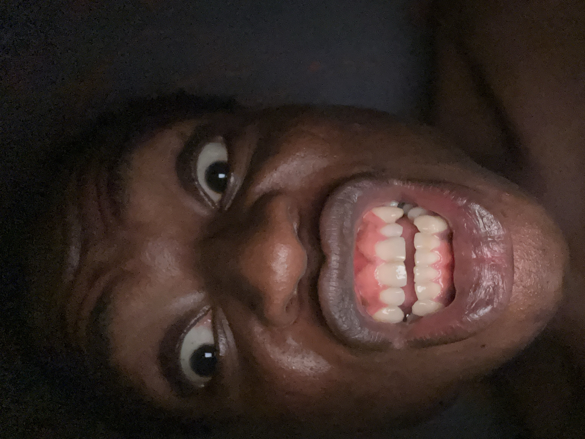 A close-up, tilted image of a person's face with their mouth open, revealing teeth and gums. The person has dark skin and dark eyes, which are wide open. The background is dark and out of focus. The image does not provide sufficient information to determine a specific location, city, or interactions. The scene solely presents a focused view of the person's facial features.