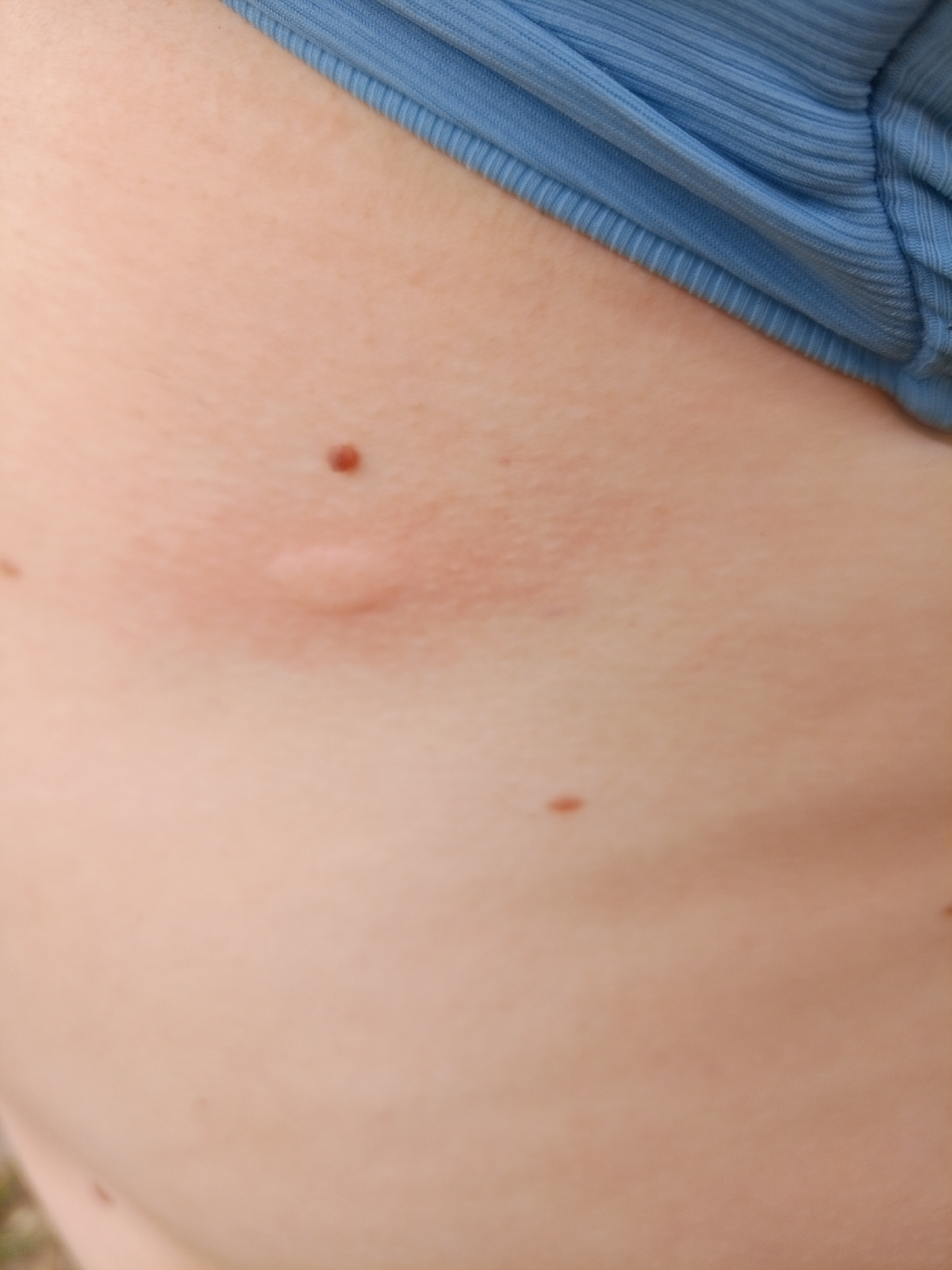 The image shows a close-up view of a person's skin, with a blue ribbed fabric garment visible at the top. The skin is light-toned and appears to have a few moles. A reddish, raised area is visible on the skin, possibly an insect bite or a mild rash. There is also a small, raised, pale bump on the skin. The background is out of focus and appears to be an outdoor environment with some green foliage at the bottom. The image does not contain any specific landmarks or clues that would indicate a location within Pankrushikha, Russia.