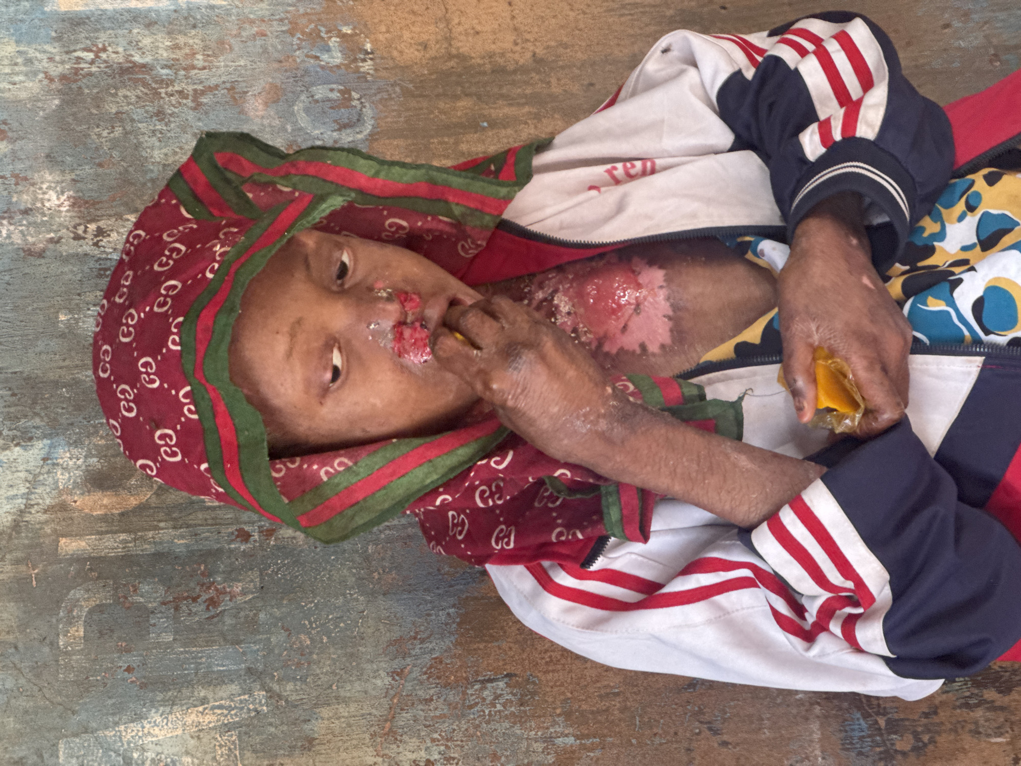 The image shows a person with skin lesions, possibly burns, on their face and chest, wearing a headscarf with a pattern of the letters "GG" repeated. They are also wearing a jacket with red and white stripes on the sleeves. The person is holding a piece of yellow fruit to their mouth. The background appears to be a textured, weathered wall. The setting is identified as Enugu, Nigeria.
