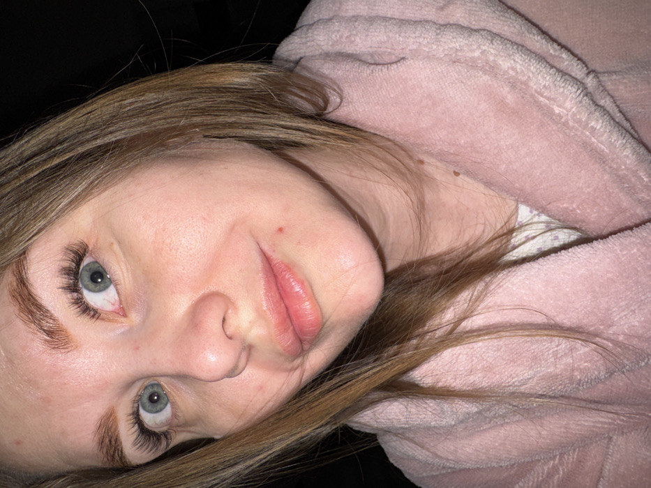 A close-up, eye-level photograph depicts a young adult female located in the city of Kochkino, Russia. The subject's face and upper torso are visible. She possesses light brown hair parted on her right, light blue-green eyes with prominent dark lash extensions, and defined eyebrows. Her skin exhibits a fair complexion with some minor redness and a small red blemish situated below the left corner of her mouth. Her lips are full and have a natural, slightly glossy appearance, with a subtle upward curve. She is dressed in a textured, light pink, plush bathrobe, worn over a light-colored garment with a faint patterned design. Several small, raised moles are present on her neck and lower right cheek. The female is looking directly forward, engaging the camera with a wide-eyed stare. The background is uniformly dark and indistinct, offering no further environmental context.