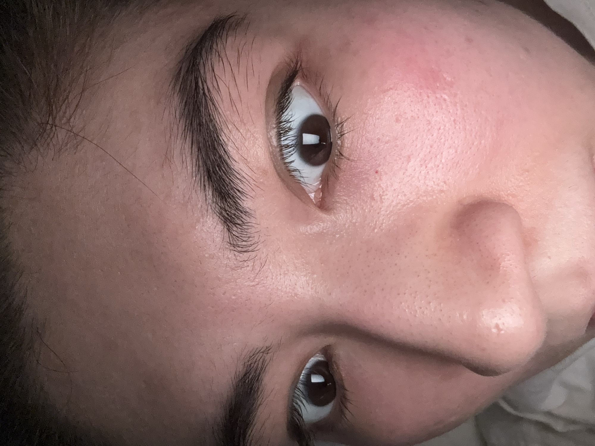 A close-up, rotated photograph shows a person's face from an extreme low-angle perspective, focusing on their eyes, nose, and forehead. The lighting is warm and appears to be artificial, highlighting the texture of the skin, including visible pores and some redness on the forehead and cheek. The person has dark eyebrows and eyelashes. One eye is clearly visible, with a dark iris and a reflection in the pupil. The other eye is partially visible at the bottom of the frame. The skin appears to be well-lit, with subtle variations in tone and texture. There are no discernible objects, text, or environmental cues that provide information about the time of day, weather, or specific location. The emotion conveyed is neutral, with the focus being on the facial features and skin details.