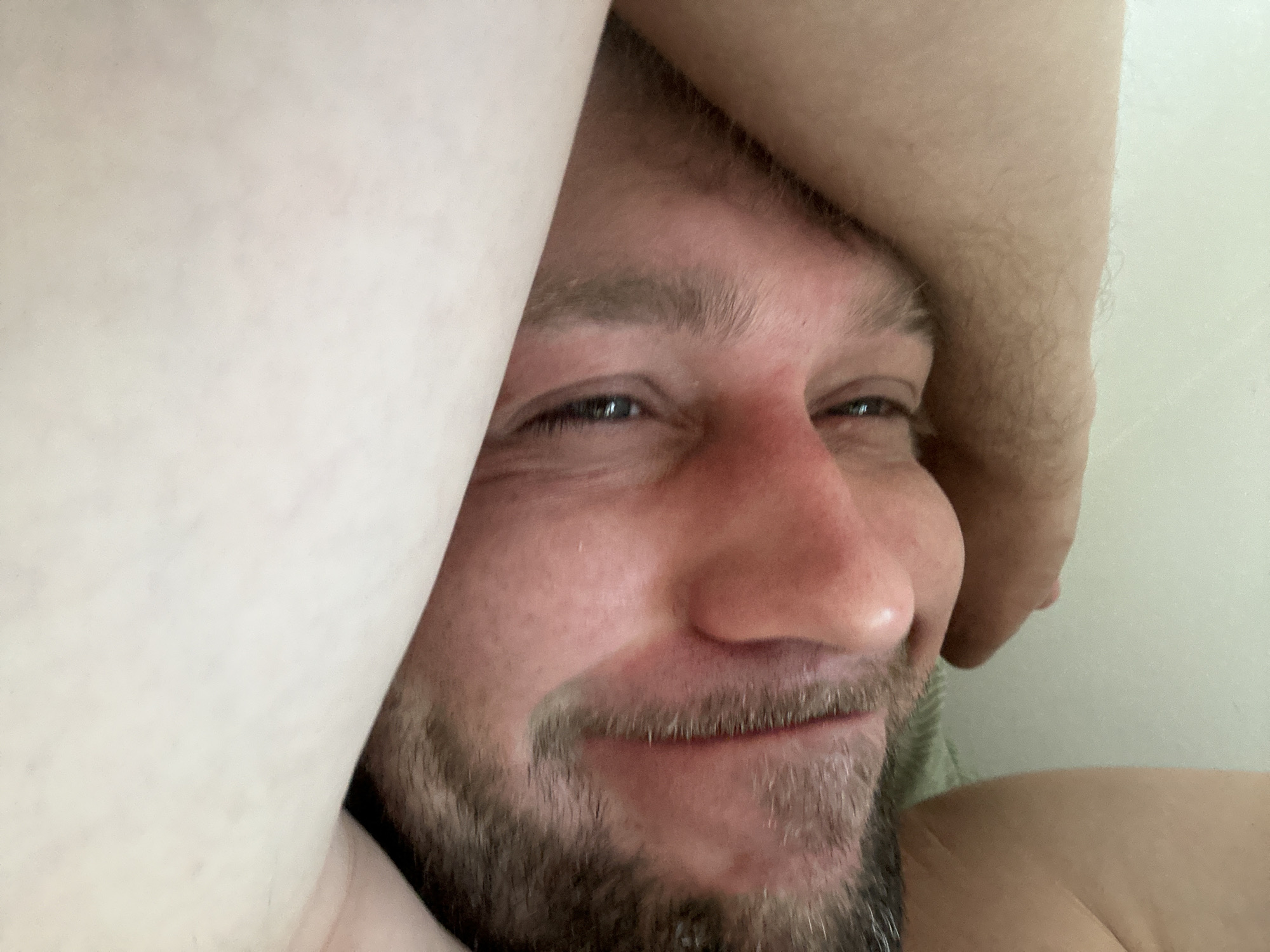 A man is lying down with his arm over his face. The man has a beard and his skin is flushed red around his nose and cheeks. He is looking at the camera with his eyes partially visible. The background is a plain, light-colored wall.