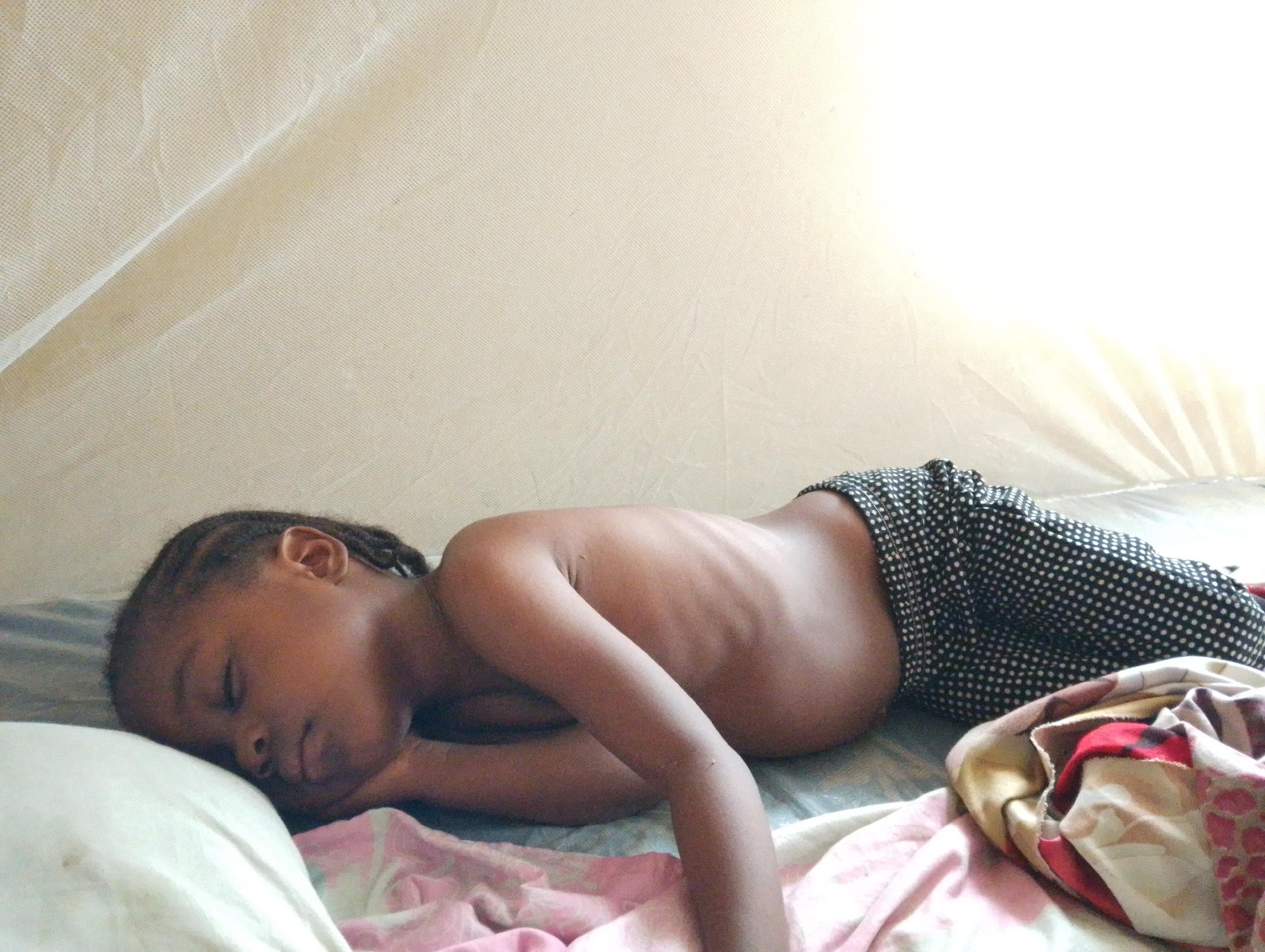 A child is lying on a bed under a mosquito net. The child is dark-skinned and has braided hair, and is wearing polka-dotted shorts. The child is sleeping on their side, with their face resting on a white pillow. The bed is covered with a patterned blanket. The location is within the city of Babban Giji, Nigeria, but no other specifics are visible to pinpoint an exact location.
