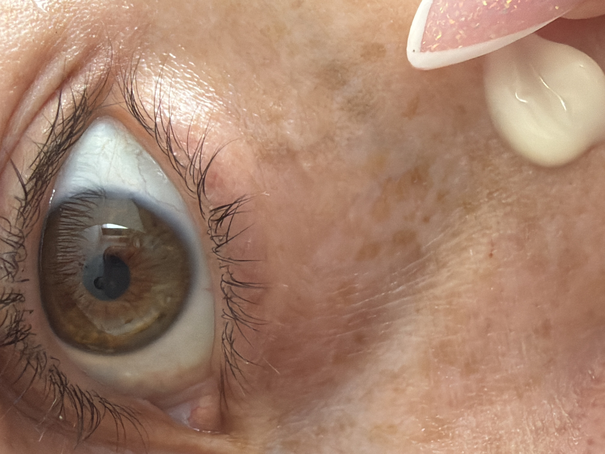 A close-up image depicts a human eye with light-brown iris and surrounding skin. The skin displays fine lines and freckled pigmentation. A drop of light-colored cream or lotion is being applied to the skin near the upper eyelid with a finger that has a nail with a white tip and pink glitter. The eye has eyelashes present on the upper and lower lids. The setting or location in Saint Petersburg, Russia, is not discernible from the provided image.