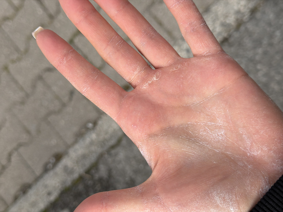The image displays a close-up, high-angle view of a human left hand, palm facing upwards. The skin of the palm and fingers is notably dry, exhibiting extensive flaking and whitish epidermal scaling, particularly prominent along the palmar creases, fingertips, and the sides of the fingers. Several small, raised flakes of skin are visible. The fingernail of the subject's ring finger (or potentially middle finger) is visible at the upper right, appearing light-colored with a squared-off tip. A dark fabric, likely a sleeve, is partially visible at the bottom left of the frame. The background is out of focus, revealing a grey, textured paved surface consistent with an outdoor pathway or plaza in the city of Budva, Montenegro, under natural daylight. The hand is presented openly, with no other individuals or objects in direct interaction.