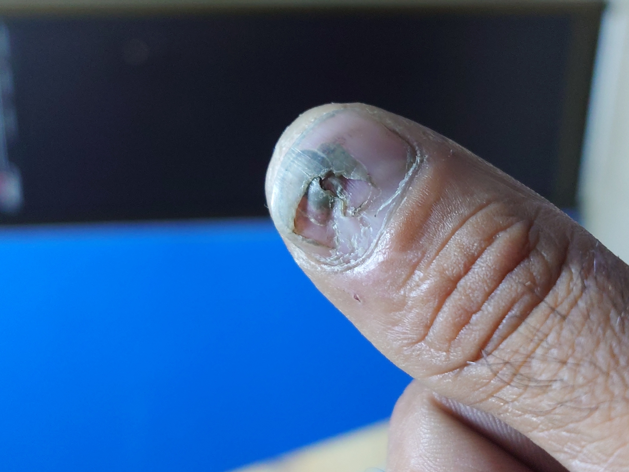 A close-up, outdoor, eye-level, full shot captures a person's thumb with a severely damaged fingernail. The thumb, positioned in the foreground, exhibits wrinkled, light-skinned texture with visible lines. The fingernail is discolored, appearing gray and green, with significant damage and what looks like peeling or flaking. The surrounding skin around the nail appears slightly red and irritated. In the background, a bright blue out-of-focus area is visible to the left, and a dark, blurry rectangle, possibly a screen or a dark wall, occupies the right side. The image is sharp and detailed, with a shallow depth of field. There is no information in the image to suggest a location in Belorechensk, Russia.