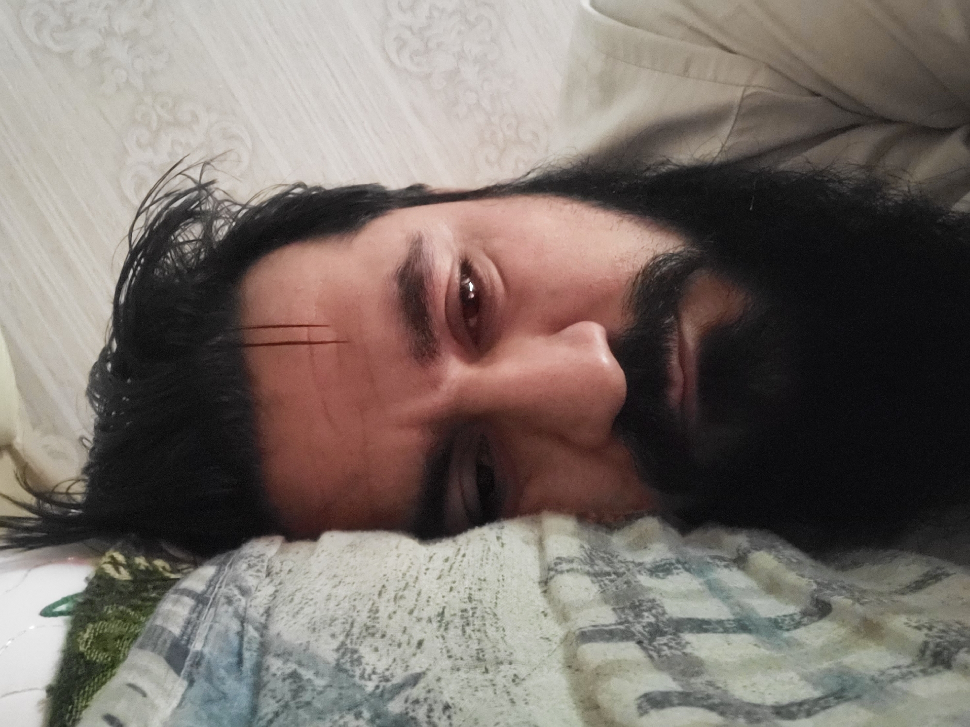 A man with dark hair and a beard is lying down on a bed with his head resting on a pillow or blanket. He has two small cuts or scratches on his forehead. His eyes are partially closed, and he appears to be relaxed or resting. The background includes a wall or headboard with a patterned design. The specific location within Quetta City Tehsil, Pakistan cannot be determined from the image.