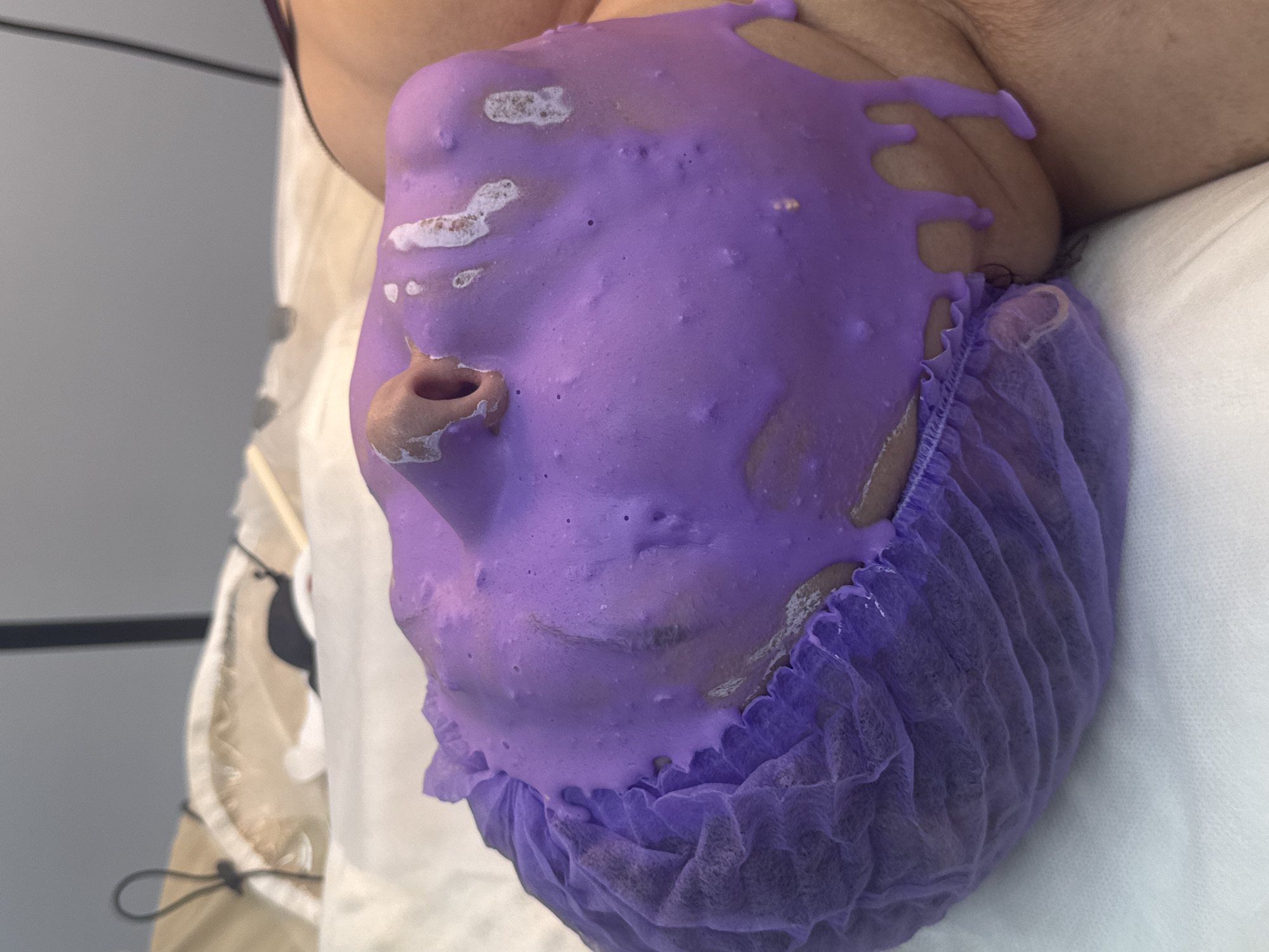 The image shows a close-up of a person's face covered in a purple mask, with a purple hair net on. The person is lying down on a white surface, which appears to be a medical bed or table. The background is blurred but suggests an indoor environment, possibly a salon or medical facility. There are no identifiable landmarks or indications of the city of Komsomolsk-on-Amur, Russia, or any specific city. The scene is a close-up of a cosmetic or medical procedure.