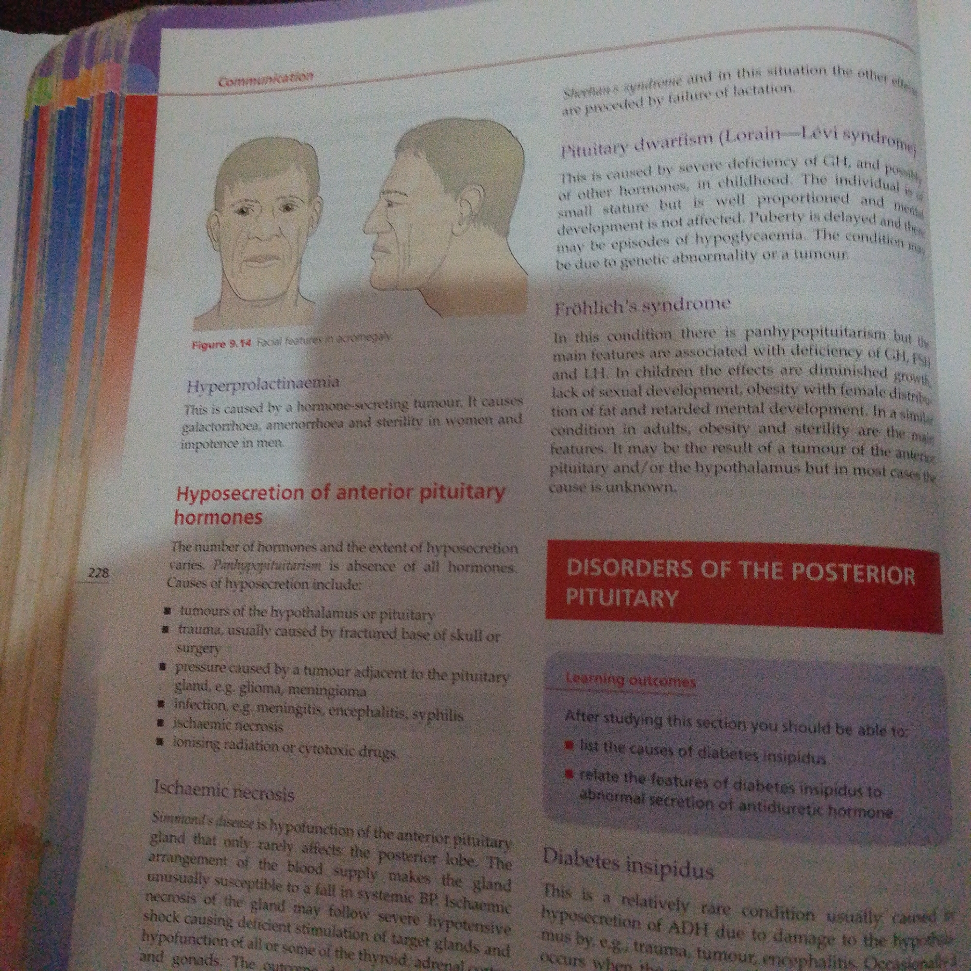 This media file is a photograph of an open book, likely a textbook, displaying educational content on human biology or medicine. The page is divided into two columns. The left column features an illustration of two male faces, one in frontal view and the other in profile, labeled as "Figure 9.14 Facial features in acromegaly." Below this, headings discuss "Hyperprolactinaemia" and "Hyposecretion of anterior pituitary hormones," with bullet points listing causes. The right column contains text describing "Sheehan's syndrome," "Pituitary dwarfism (Lorain-Lévi syndrome)," and "Fröhlich's syndrome." A red-colored section at the bottom of the right column is titled "DISORDERS OF THE POSTERIOR PITUITARY" with "Learning outcomes" listed below it, mentioning "Diabetes insipidus." The page number "228" is visible in the bottom left corner. The lighting suggests an indoor environment, typical of a study or library setting. There are no discernible emotions or weather cues. The content and illustration suggest a focus on endocrinology and hormonal disorders. No specific location cues for Jalingo, Nigeria are present in the image itself.
