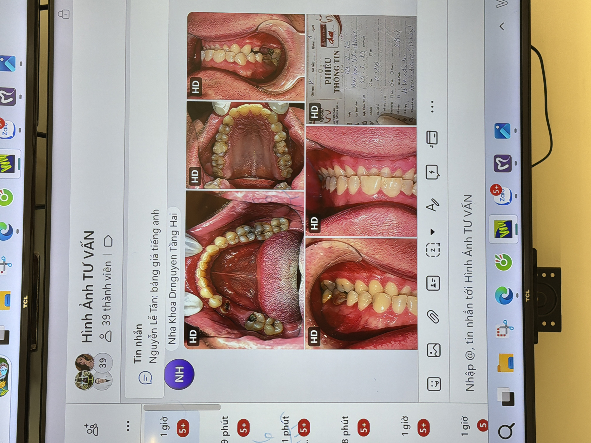 This media file appears to be a screenshot of a mobile device displaying a social media or messaging application, likely on a digital display such as a TV. The screen is oriented vertically.
The main content features a grid of four close-up images of a person's teeth and mouth, highlighting dental conditions. Each image is marked with "HD." To the right of these images, there is a form with handwritten Vietnamese text, possibly a patient information sheet or a dental treatment record. Visible text on this form includes "PHIẾU THÔNG TIN" (Information Sheet), names like "Novikov. Vladimir," and dates.
Below the dental images and the form, there is a social media interface with profile pictures, user names like "Nguyễn Lễ Tân," and timestamps indicating activity such as "9 phút," "1 phút," "8 phút," and "1 giờ" (minutes and hours). One section is labeled "Hình Ảnh TƯ VẤN" (Consultation Images) and mentions "39 thành viên" (39 members). Another section displays the text "Nha Khoa Drnguyen Tầng Hai" (Dr. Nguyen Tang Hai Dental Clinic).
The bottom portion of the screen shows a dock of application icons, including Zalo, Google Chrome, and other system icons, along with text indicating chat or message input area with options like "Nhập @, tin nhắn tới Hình Ảnh TƯ VẤN" (Enter @, message to Consultation Images).
The overall scene is a digital interface, likely in a modern setting, showcasing dental information and communication features. The presence of Vietnamese text strongly suggests the location context is Vietnam. The context implies a dental consultation or follow-up being documented or shared digitally.