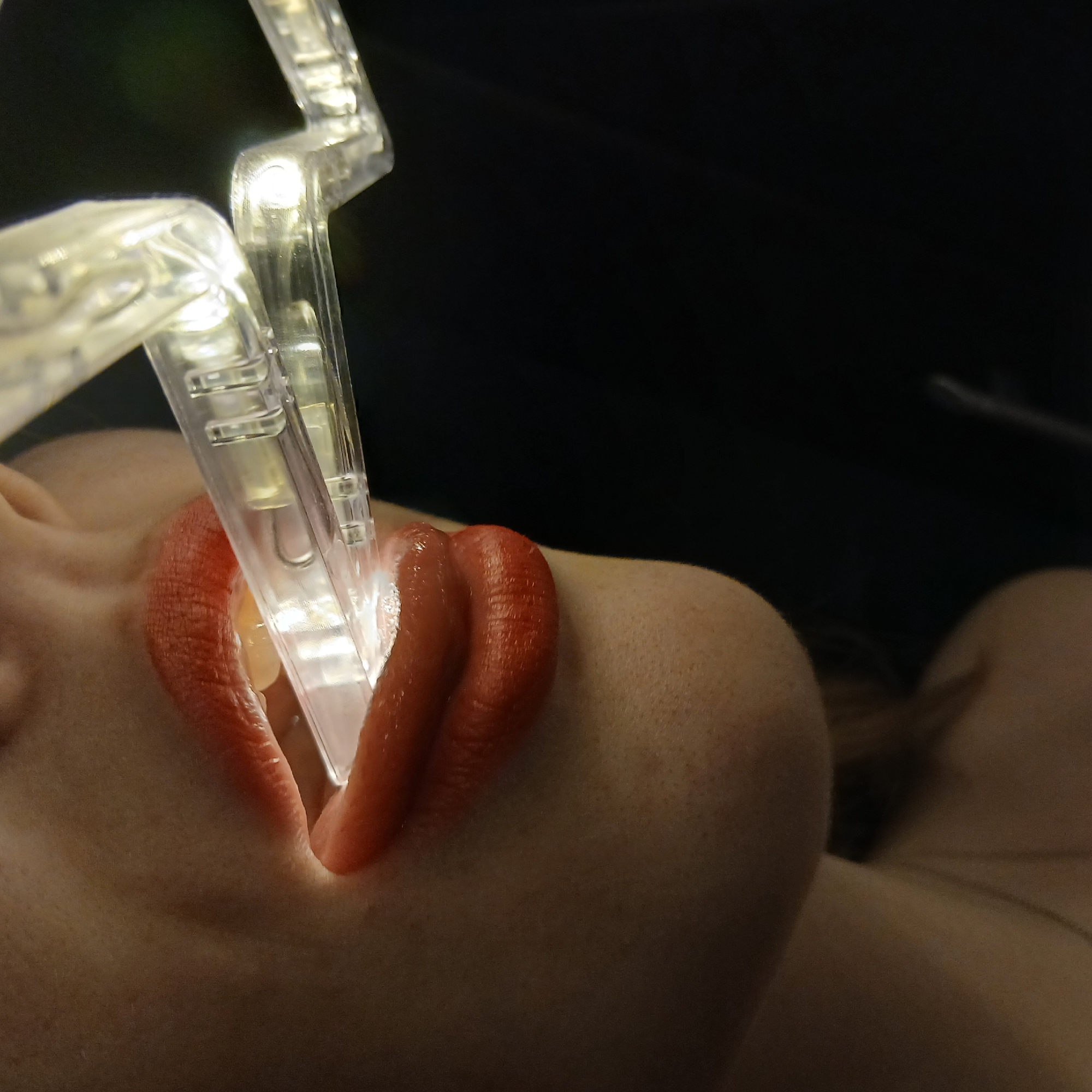 A close-up, side-profile image captures a person's mouth with a clear, light-emitting device inserted. The lips are painted with vivid red lipstick, providing a strong color contrast against the pale skin. The device, seemingly made of transparent plastic segments, glows brightly from within, illuminating the inside of the mouth and casting light onto the adjacent skin. Several small internal light sources, likely LEDs, are visible within the clear structure.
The individual's chin and neck/shoulder area are visible, suggesting a close-up of the upper body. The background is entirely dark, indicating a low-light environment, possibly indoors at night or in a studio setting, where the device's light is the primary illumination. The activity appears to be an artistic performance, a fashion statement, or the use of a novelty item, rather than a medical procedure, given the aesthetic presentation of the lipstick. No specific emotions are discernible from this tightly cropped view. The scene is situated in Yekaterinburg, Russia. There is no visible text in the image.