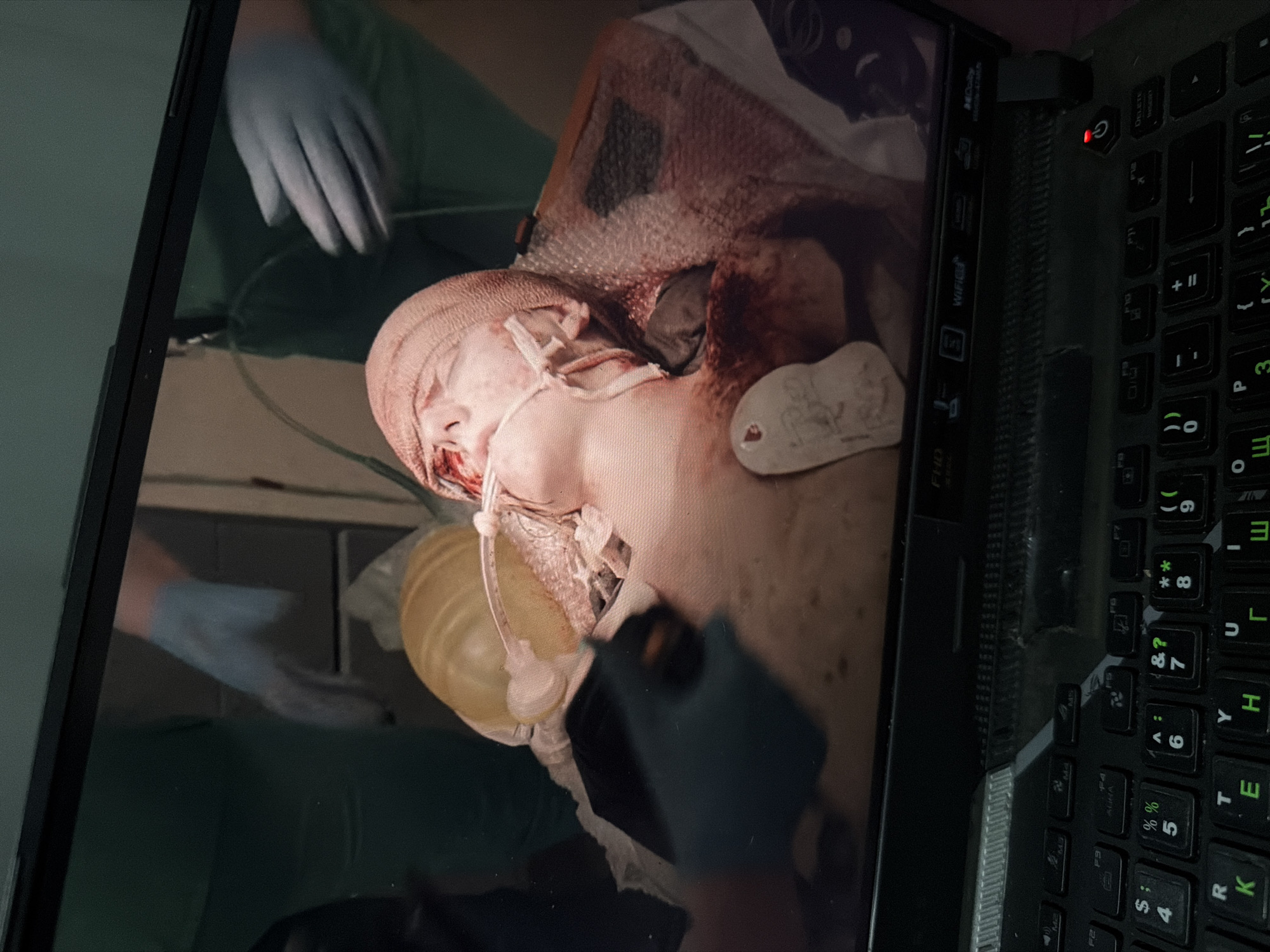 The image displays a close-up view of a person's head and upper body on what appears to be a medical display screen, possibly in a hospital setting. The person is lying down and has bandages wrapped around their head and neck, with medical tubing inserted. There are signs of blood. In the foreground, a laptop keyboard is visible, suggesting the screen might be a monitor connected to a computer. The environment depicted on the screen shows medical personnel in surgical attire and gloves, with medical equipment. The background is blurred and indistinct. There is no indication of the city of Baan Mae Nam, Thailand, or any specific geographical location.
