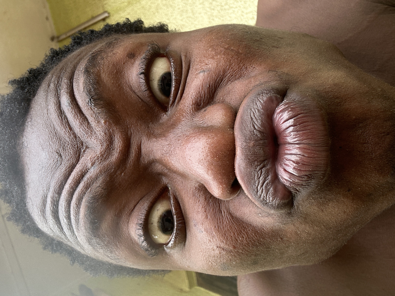 A close-up, high-angle portrait shows a person with dark skin making a humorous, exaggerated facial expression. The face is tilted significantly to the left, appearing almost sideways within the frame. The subject's forehead is deeply furrowed, creating multiple horizontal wrinkles. Their dark, curly hair is visible along the top of the head.
The eyes are wide open, with the whites (sclera) appearing slightly yellowish. The irises are dark brown, and the pupils are visible. Eyelashes are short and dark. The person's lips are tightly pursed and pushed forward into a prominent "fish face" or pout, showing the textured lines of the lips. The skin has visible pores and a natural texture.
The background is blurry and out of focus, appearing as a light, possibly yellowish-green, surface. A faint metallic object, resembling a pipe or rod, is partially visible in the top-left corner of the original image. The lighting is soft and even, suggesting either natural light indoors or well-diffused artificial light. There is no visible text. The overall impression is one of playful or silly self-expression.