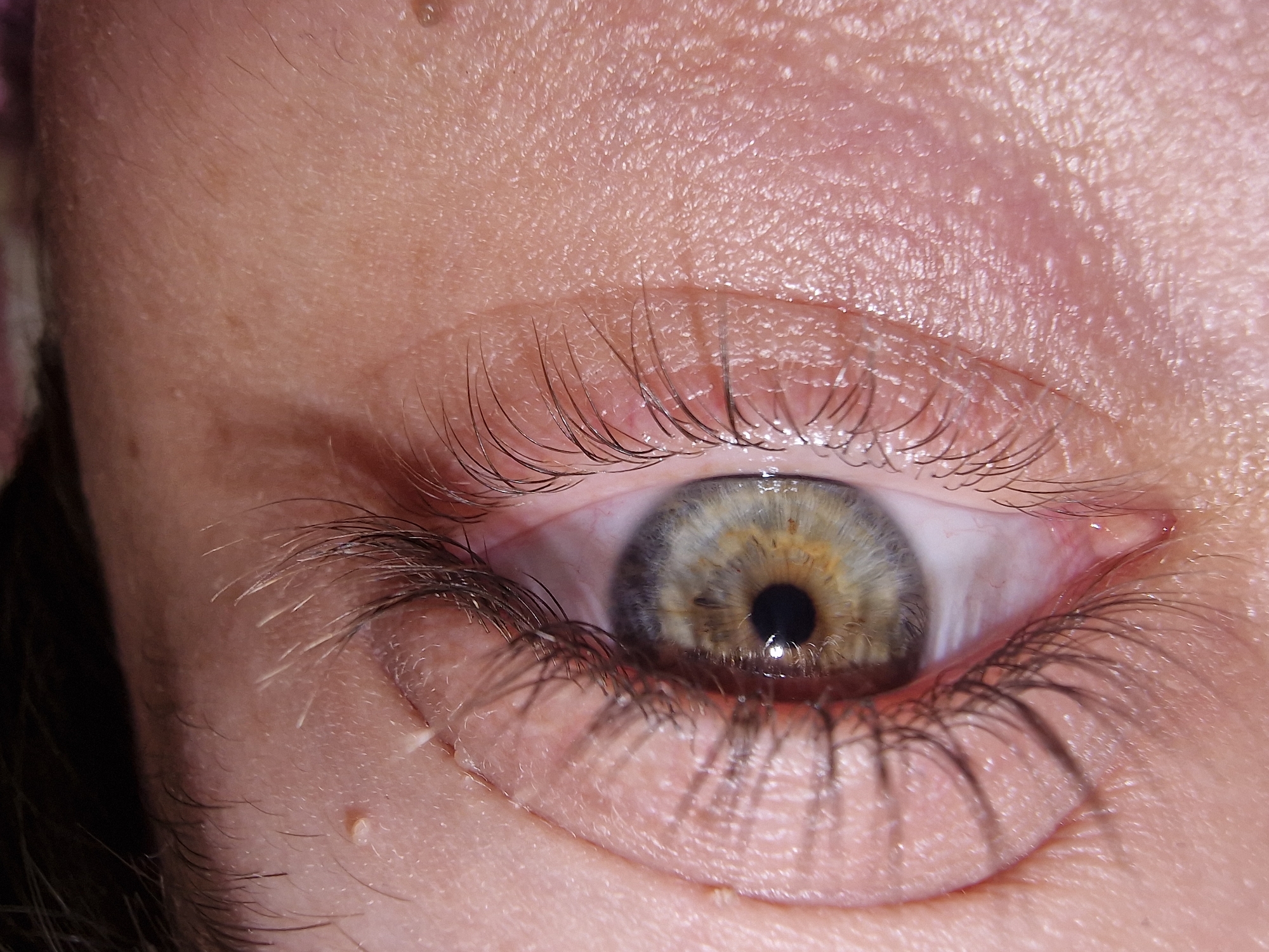 A macro, close-up shot captures a human eye. The eye, appearing to belong to an adult, is wide open and gazes directly forward. The iris exhibits central heterochromia, featuring a distinct golden-brown ring around the black pupil, transitioning to a light blue-grey color in the outer portion. A clear, bright reflection, possibly from a ring light or artificial light source, is visible within the pupil and slightly on the iris surface, indicating direct illumination.
The sclera (white of the eye) shows slight redness, particularly towards the inner corner. Long, dark, and well-defined eyelashes frame both the upper and lower eyelids. The skin surrounding the eye is visible in high detail, showcasing its natural texture, pores, and some fine vellus hairs. There are several small, light-colored bumps visible on the skin, including one prominent, yellowish bump below the lower lash line and other smaller, white-ish bumps (possibly milia) scattered across the upper eyelid and eyebrow area. A tiny, clear droplet, possibly sweat or a tear, can be seen just above the upper lash line. The eyebrows are partially visible in some crops, showing dark hairs mixed with some lighter, almost white, individual strands. The overall lighting is bright and even, highlighting the intricate details of the eye and surrounding skin. No text is visible in the image. The setting, time of day, and any specific activity or emotion are not discernible beyond the act of observing.