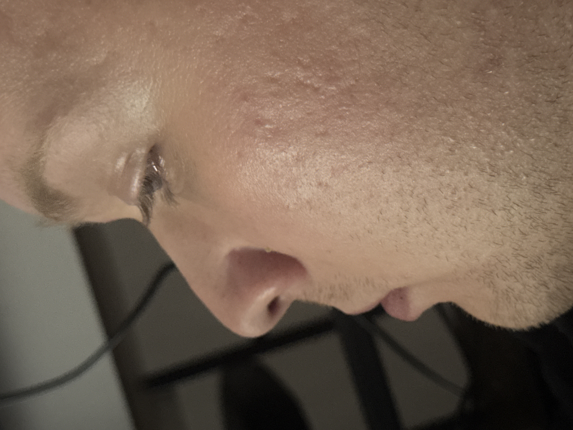 This is a close-up, profile view of a person's face, focusing on the right side of their nose, cheek, and eye. The individual appears to be an adult male with fair skin and some stubble on his jawline. The skin on the cheek shows some texture and what appear to be minor acne scars or enlarged pores. The eye is partially visible, with eyelashes and a hint of the iris. The background is dark and out of focus, suggesting indoor lighting. There is no information about the location of Saratov, Russia, present in this image.