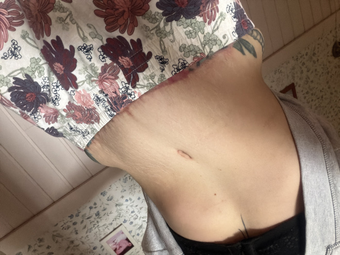 The image displays the midsection of an individual, presenting the bare abdomen and hips. The subject wears a black lace top, with a grey garment pulled upwards to expose the stomach. Floral-patterned pajama bottoms, featuring large dark red, pink, and light green blooms on a white background, cover the lower body. The skin on the abdomen exhibits light stretch marks and contains a horizontal navel. Two faint, linear reddish marks are visible on the lower left abdomen, proximate to the pajama waistband. A dark, angular tattoo extends from the upper left abdomen, and a tattoo featuring green leaves is visible on the lower left hip beneath the waistband. The background comprises a wall covered in light-toned floral wallpaper, below which light-colored wooden paneling or floorboards are present. A small framed photograph, depicting indistinct figures, hangs on the wallpaper in the upper right quadrant. The specific location within Chaikovsky, Russia, cannot be determined from the visual content.