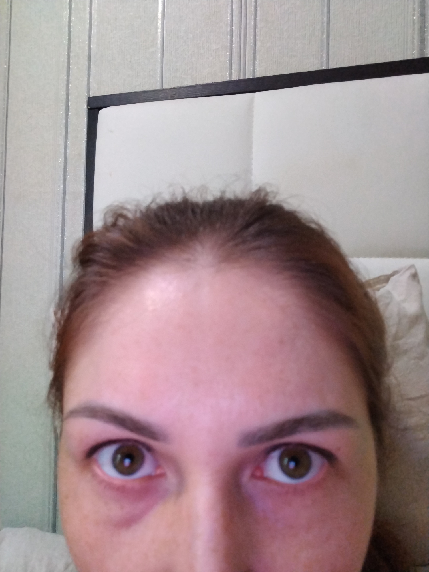 A close-up portrait shows a person, likely female, from the forehead to the upper cheeks. The subject has brown hair, which appears pulled back from the forehead. Her skin is fair, with some visible freckles on the cheeks and under-eye area. The eyes are wide open, featuring dark brown or hazel irises and well-defined, dark eyebrows. Dark eyeliner or kajal is applied to the lower lash line. There is noticeable darkness and discoloration under both eyes, particularly under the subject's right eye (viewer's left). The gaze is directed straight at the camera.
The background suggests an indoor setting, likely a bedroom. Behind the person's head, a white upholstered headboard with a central fold is visible, topped by a dark wooden or metal frame. A light-colored wall with vertical textured stripes, possibly wallpaper or paneling, is visible to the left and above the headboard. A light-colored pillow is partially visible on the right side of the image, behind the subject. The lighting appears to be indoor. No text is visible.