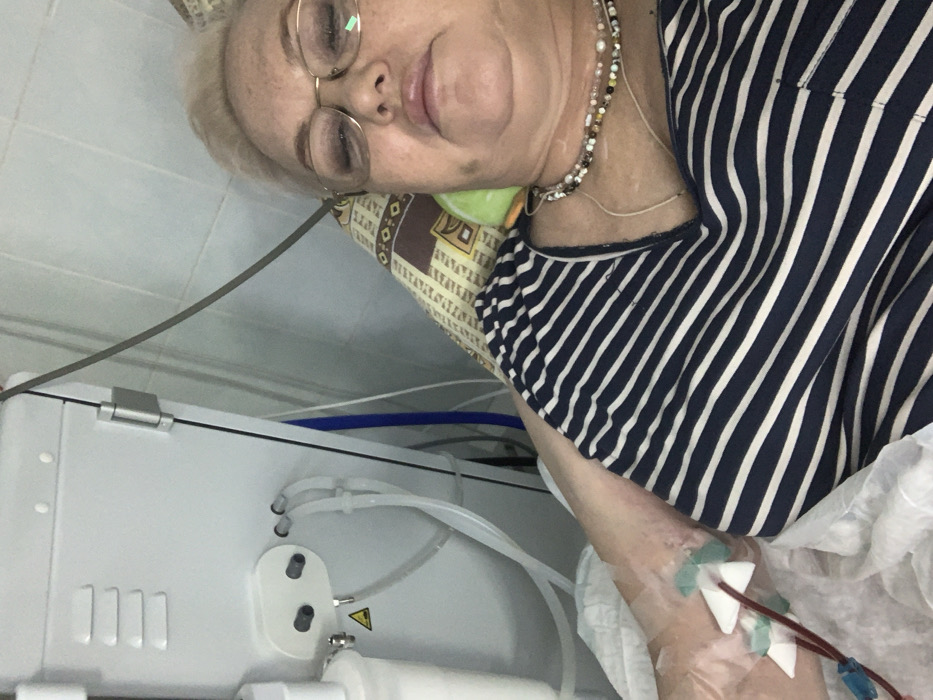 An older woman with fair hair and glasses lies on a patterned pillow wearing a striped shirt. A medical machine with tubes is positioned next to her. Two tubes are inserted into her arm, secured with tape and bandages. She is undergoing a medical procedure, likely dialysis, given the visible equipment and arm cannulation. Her expression is neutral, and she is wearing a beaded necklace. The setting appears to be a clinic or hospital room.