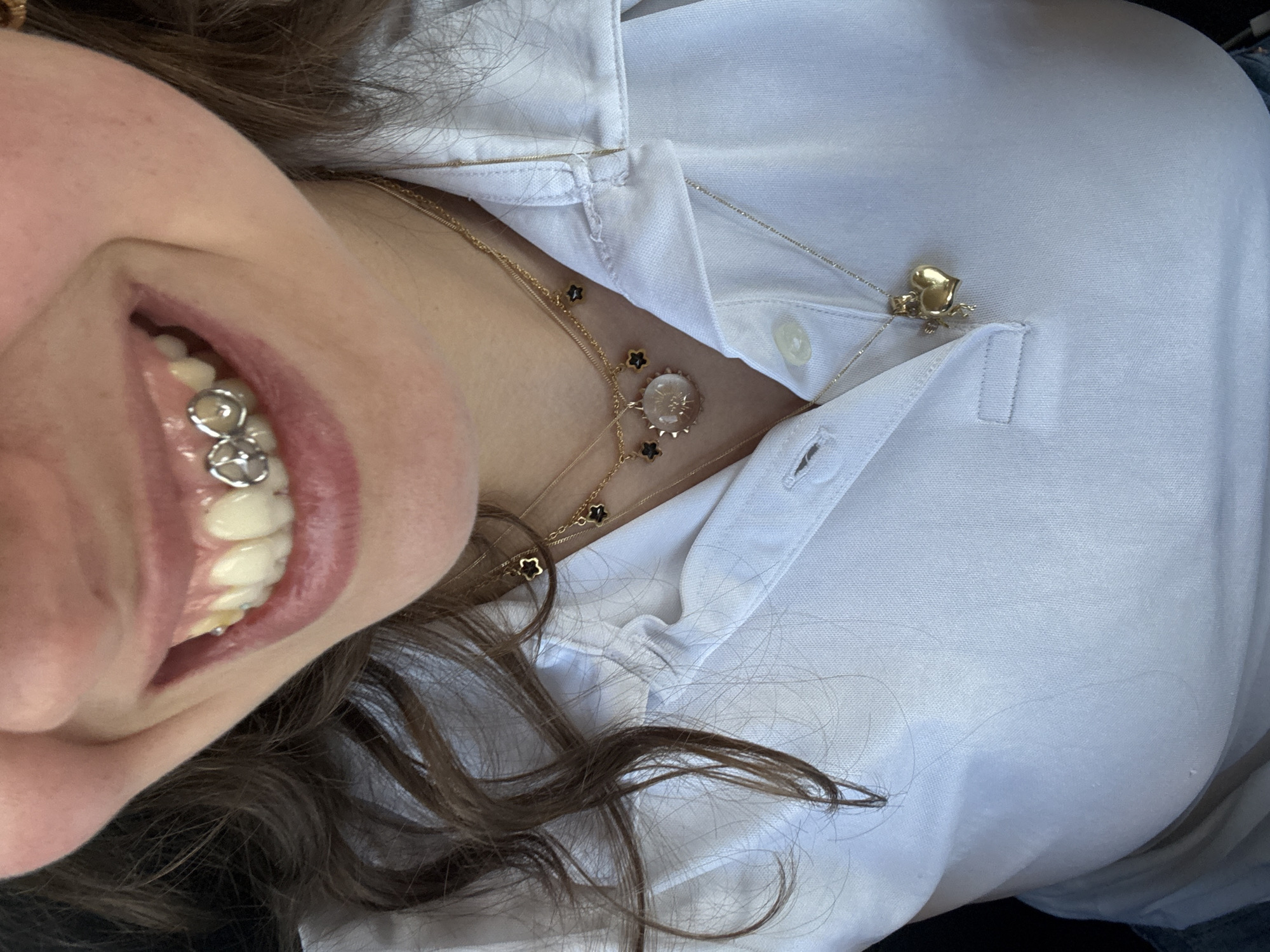 A person wearing a white collared shirt is photographed from a low angle, showing their face, neck, and part of their chest. They are smiling, revealing a dental appliance of silver or white metal on their lower teeth. They are wearing at least two necklaces, one with small black flower-shaped charms and another with a golden heart-shaped pendant. The location is not discernible from the image.