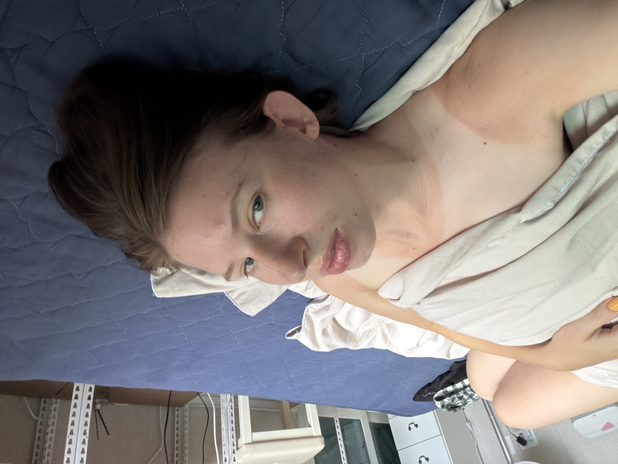 A young woman with light skin and brown hair lies on a dark blue quilted bed. Her body is partially covered by a light-colored blanket. She has visible sunburn on her chest and shoulders, with a distinct tan line around her upper chest and under her arms. Her face is turned towards the camera, with her eyes open and looking slightly to the side. She is wearing a light-colored top that is pulled down, exposing her chest and shoulder. The background shows a plain wall, a white drawer unit with two knobs, and a white shelf unit with electrical cords. The scene appears to be indoors, possibly in a residential setting. The image was taken in Dongducheon-si, South Korea.
