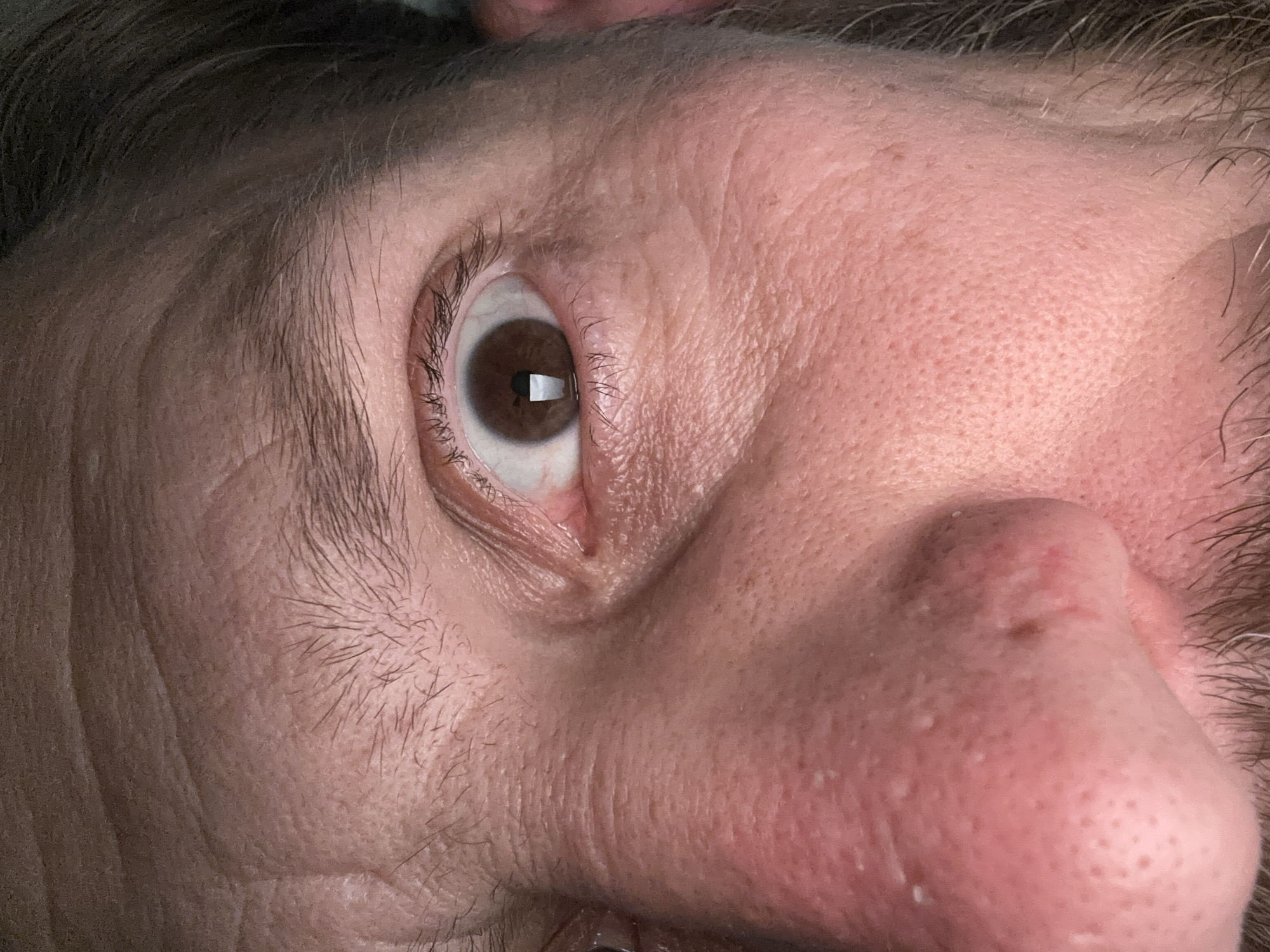 The image is a close-up, upward-angle shot of a person's face, focusing primarily on the eye and nose area. The eye, which is the clearest focal point, has a brown iris. The skin appears to have wrinkles and visible pores. The nose has some surface irregularities and minor discoloration. Sparse hair is visible above the eye. The environment or specific location within Fethiye, Turkey, cannot be determined from the image.