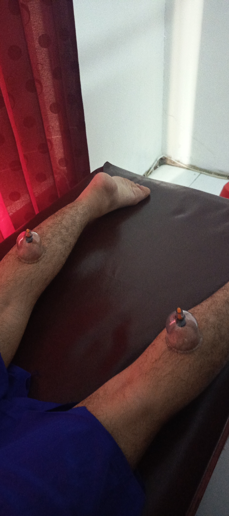 The image shows a close-up of a person's legs with two glass cups applied for cupping therapy. The person is lying on a dark brown surface, possibly a massage table or bed. The cups are transparent, with orange and black suction mechanisms at the top. The lighting is dim, with a red hue cast from a curtain on the left side of the frame. The background shows a white wall and a corner where the wall meets the floor, with some visible debris. The image is cropped to focus on the legs and the cupping therapy equipment. The location is identified as Sukaresmi, Indonesia, but no specific landmarks or context are provided within the image itself to confirm this location. The person's body is partially visible, wearing blue fabric on the lower leg. The scene appears to be indoors, in a treatment or therapeutic setting.