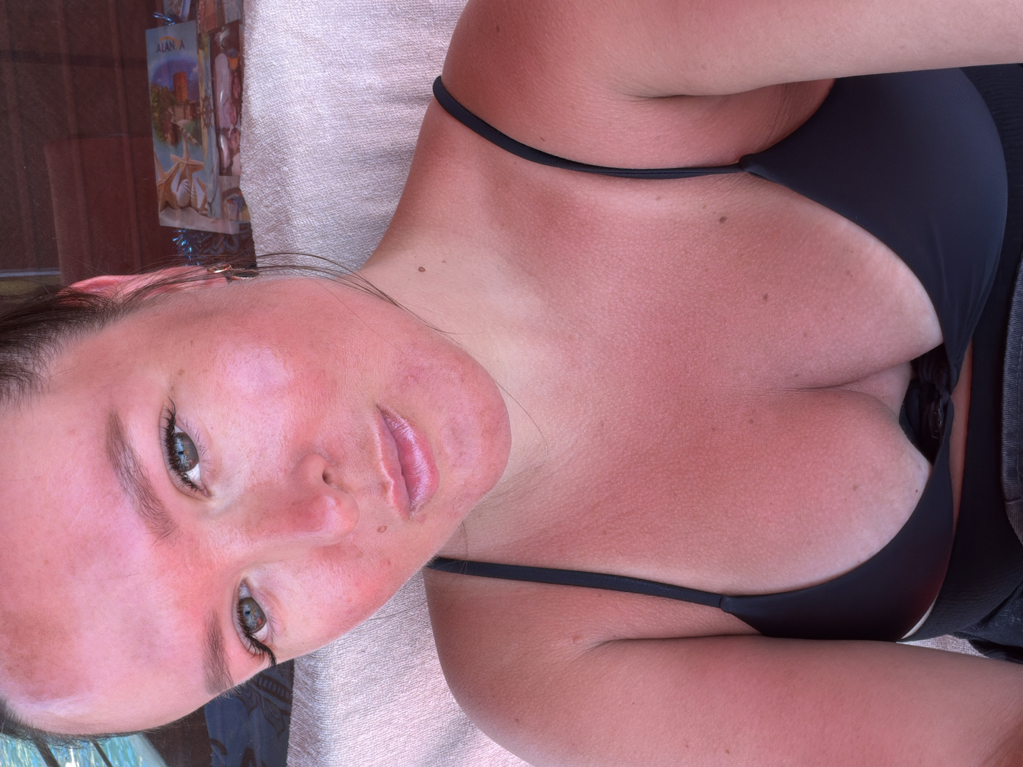 The image presents an overhead close-up view of a person, likely a woman, lying down. Her face and upper body are prominently featured, revealing a severe sunburn across much of her exposed skin. Her face, neck, chest, and arms are a vivid red, with distinct tan lines visible where the straps of her black bikini top covered her skin.
She is wearing a black bikini top with thin straps. Her light-colored eyes, possibly blue or green, are open and directed towards the viewer, while her lips are slightly parted in a neutral expression. Dark hair is visible around her head and shoulders.
The person is resting on a textured, light-colored fabric, which could be a towel or a bedsheet. In the upper left background, some small decorative items or pictures are discernible, one displaying the partial text "ALAN A," indicating the location is Alanya, Turkey, as per context. The activity appears to be one of relaxation, possibly after sunbathing, given the prominent sunburn. The bright, direct lighting suggests it is daytime and sunny, leading to the evident sun exposure.