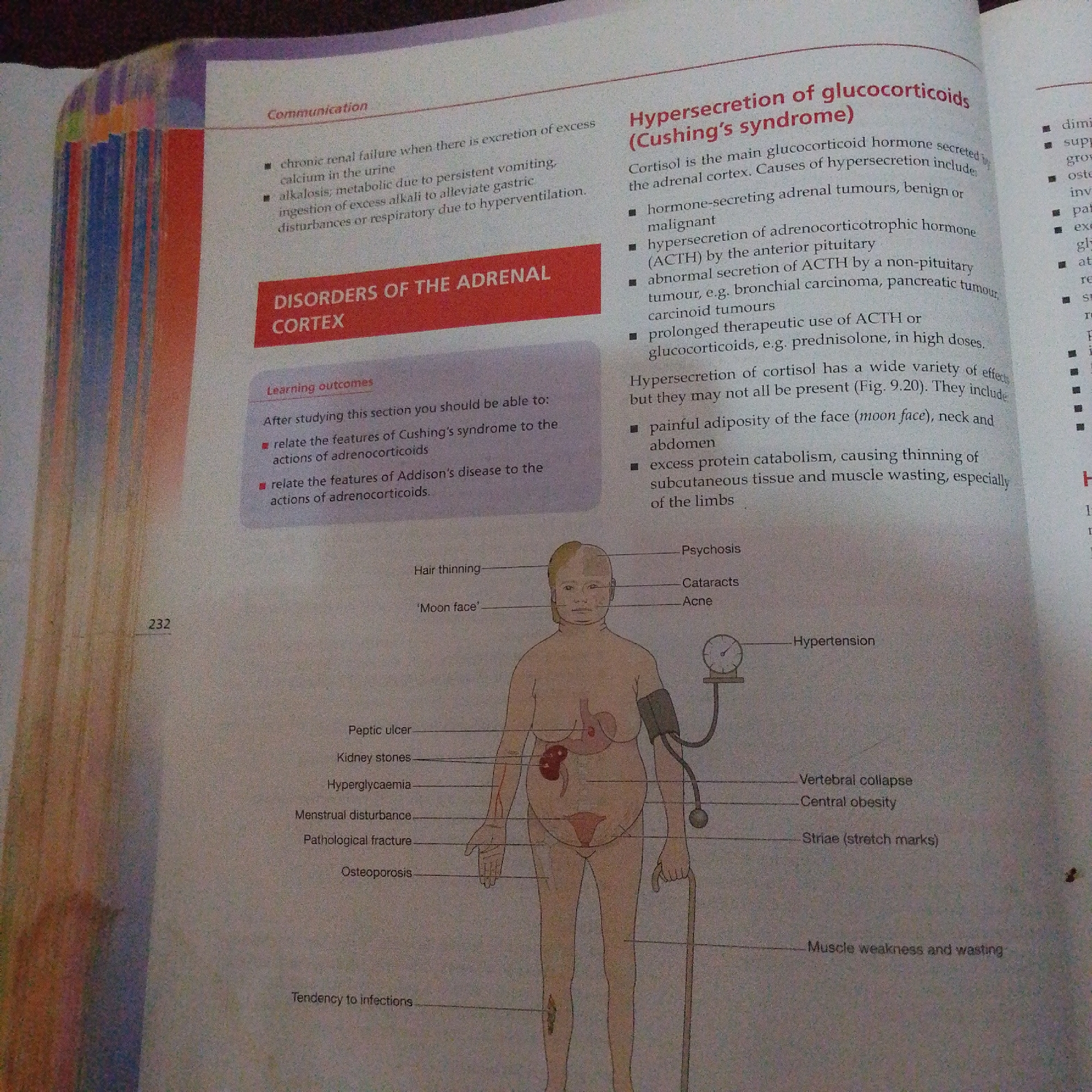 The image is a scanned page from a medical textbook. It depicts a diagram illustrating the symptoms of Cushing's syndrome, also known as hypersecretion of glucocorticoids. The diagram shows a stylized human figure with labels pointing to various physical manifestations of the condition, such as "moon face," "hair thinning," "psychosis," "cataracts," "acne," "hypertension," "peptic ulcer," "kidney stones," "hyperglycaemia," "menstrual disturbance," "pathological fracture," "osteoporosis," "vertebral collapse," "central obesity," "striae (stretch marks)," and "muscle weakness and wasting." The text provides information about the causes and effects of glucocorticoid hypersecretion. There is no information about Jalingo, Nigeria, or any forensic details.
