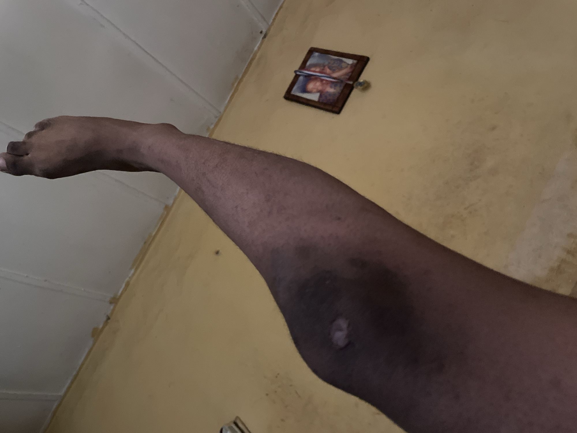 The image shows a person's left leg and foot from the knee down, angled upwards. The leg has a large, dark bruise covering the knee area, with a lighter, possibly scabbed or healing wound on the kneecap itself. The skin tone is dark. The leg is positioned against a yellow wall with a white ceiling above. A framed picture containing two individuals is visible on the wall in the background. The environment appears to be indoors, possibly a residential setting, in Lokoja, Nigeria. The lighting suggests it is either daytime or a well-lit indoor space. The perspective is from below the leg, looking up.