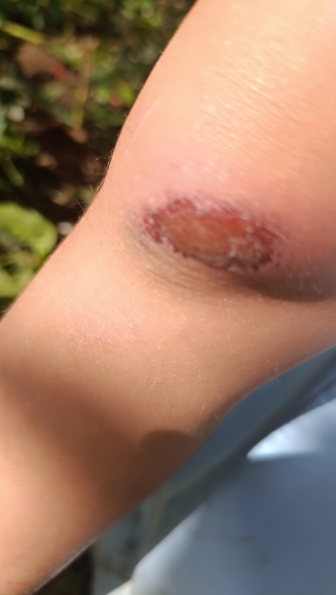 The image shows a close-up of a scraped knee with a wound. The wound appears to be healing, with some redness and dried blood around the edges. The skin is light-skinned and has fine hairs visible. The background is blurred and appears to be outdoors, with green foliage and sunlight visible. There is no indication of a city location or any other contextual information.