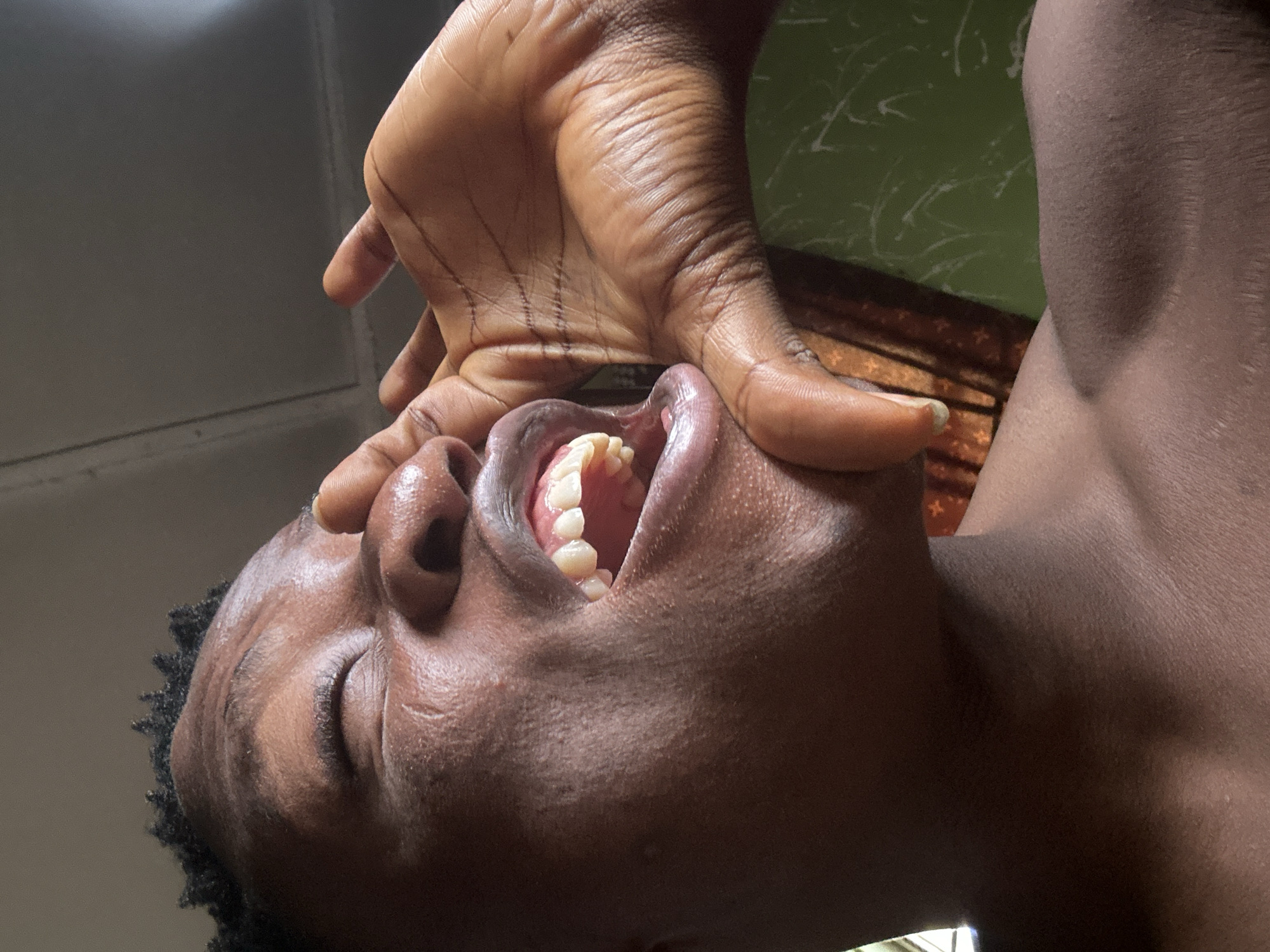 The image is an extreme close-up, low-angle shot of a person's face with their mouth open and their hand pulling on their cheek. The individual's skin is dark and appears to be slightly sweaty. Their teeth are visible inside the open mouth, and their eyes are closed. The hand is also dark-skinned, with prominent wrinkles and lines. The background is blurry, with a green, textured wall and what appears to be a patterned curtain on the right. The lighting suggests it might be daytime, possibly indoors. The overall impression is one of discomfort or distress, given the facial expression and the action of the hand. There is no visible text in the image. The location context provided is Ikorodu, Nigeria.