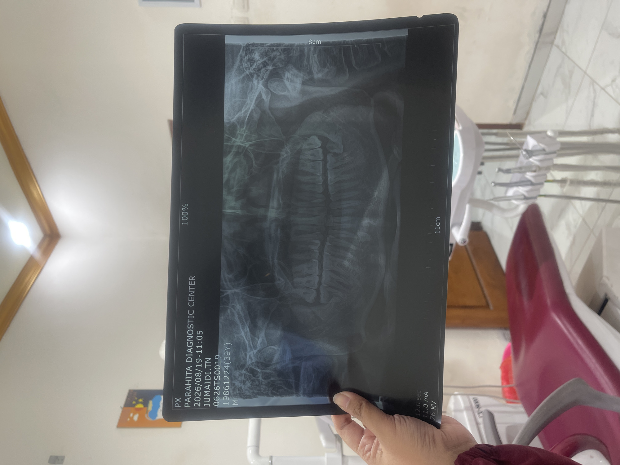 A person's hand holds a dental panoramic X-ray image in front of a wall with a painting. The X-ray displays the patient's jawbone and teeth. Text on the X-ray indicates "PARAHITA DIAGNOSTIC CENTER," "2026/08/19-11:05," and "JUMAIDI.TN." The background shows a dental clinic environment with a dental chair and equipment. The location is identified as Balongdowo, Indonesia.
