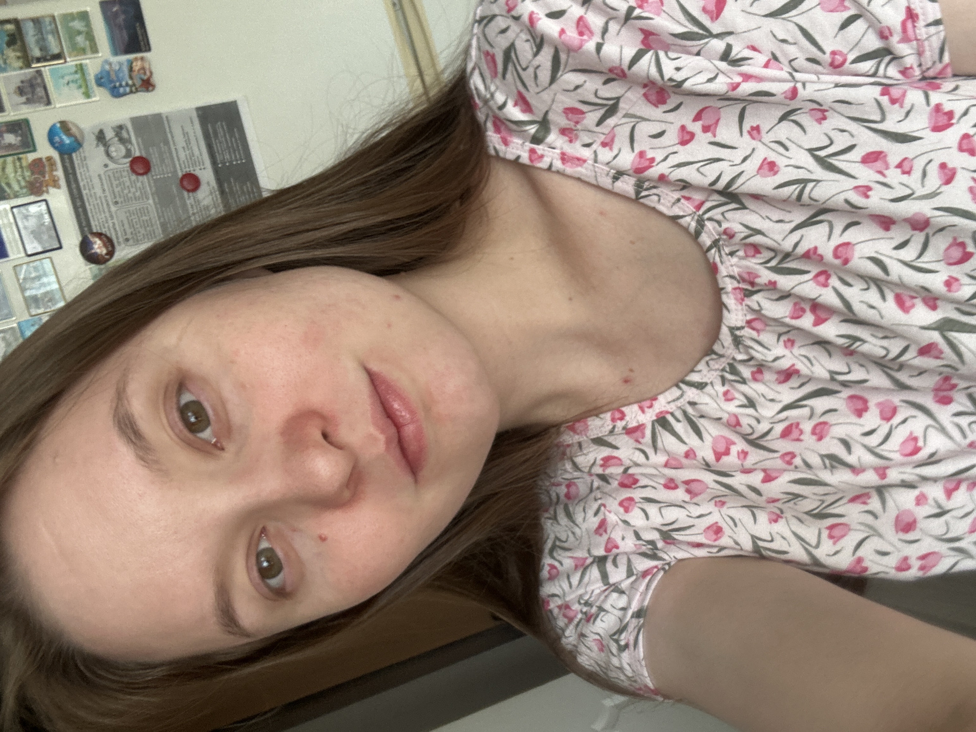 A young woman with long brown hair and brown eyes is looking at the camera. She is wearing a light pink t-shirt with a floral pattern of pink tulips and green leaves. Her skin appears fair with some redness on her cheeks and nose, and a few small blemishes. There is a mole on her right cheekbone. The background behind her is a white wall with several magnets and papers attached to it. The lighting suggests an indoor setting, possibly a kitchen or living area. The image quality is moderate, with some visible grain. The scene appears to be captured in a residential environment.
