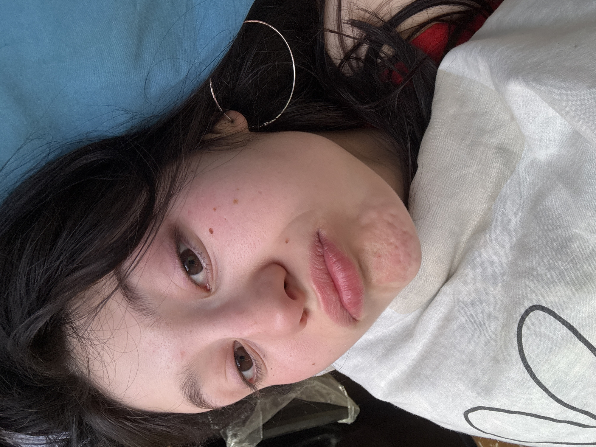A close-up, diagonal portrait, captured in Foki, Russia, shows a young female lying down with her head tilted to the right. She has dark hair, brown eyes, and light skin displaying redness on her cheeks and a prominent red, textured patch on her chin. Her lips are full and pursed in a pout, and she wears a silver-colored hoop earring in her visible right earlobe. The subject is looking directly into the camera. A white fabric, patterned with a black outline design, covers her upper left torso. A red garment is partially visible beneath her hair on the lower left. Her head rests on a turquoise-colored pillow. The background behind her head is dark and indistinct, suggesting an indoor setting.
