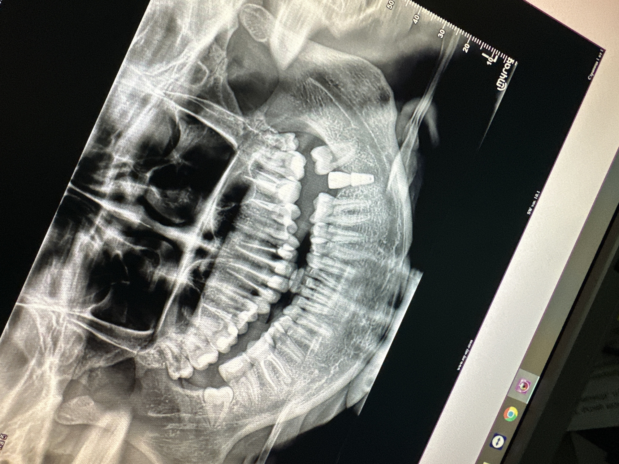 This image is a panoramic dental X-ray displayed on a computer monitor, showing the teeth and jaw structure of an individual. The X-ray highlights dental implants and natural teeth. The monitor screen is visible in the foreground, showing the X-ray image and parts of the computer's graphical user interface, including icons and a website address "www.my-ray.com". There is also a scale marked on the side of the X-ray image. The context of Varna, Bulgaria, is not discernible from the image itself.