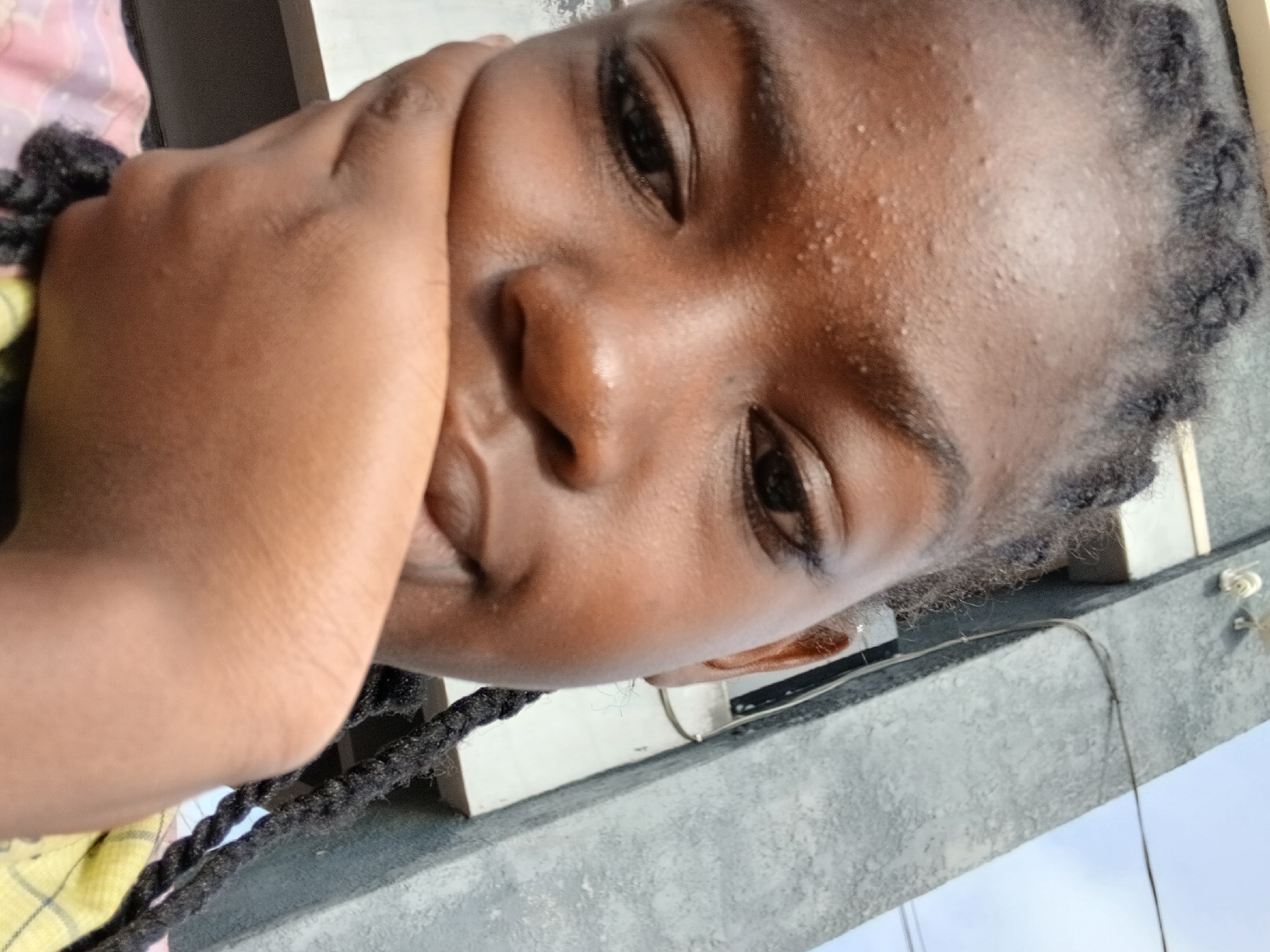 A close-up, tilted portrait shows a young person with dark skin, likely outdoors in Jos, Nigeria, during daylight hours. The subject is positioned at an angle, with their right eye and part of their nose visible as they look towards the camera. Their left hand is raised to their face, covering the lower part of their cheek and mouth.
The person has dark, braided hair, appearing to be dreadlocks, which frame the face and extend downwards. A notable detail is the prominent texture or numerous small bumps visible across the forehead and upper cheek, possibly indicating sweat or a skin condition. The lighting is bright, casting some highlights on the skin.
In the background, a light gray, textured surface, possibly a building wall or concrete beam, is visible, along with some thin wires. A sliver of clear, light blue sky can be seen at the bottom right. A hint of yellow and plaid fabric, likely part of the person's clothing, is visible on the far left. The overall mood appears neutral or pensive. There is no visible text in the image.