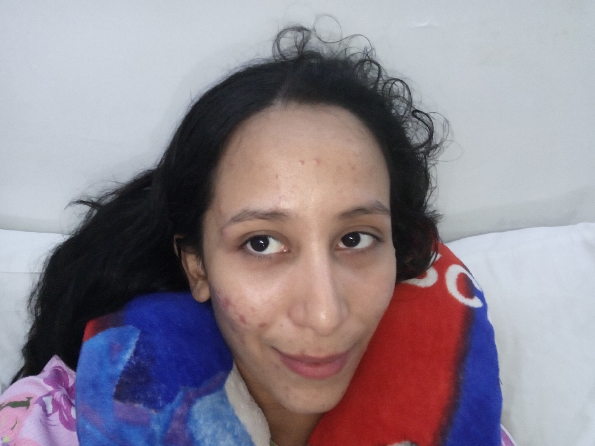 A woman with long, dark hair is lying in bed against a white pillow and wall. She is partially covered with a blue and red blanket. She has clear facial features with blemishes on her forehead and cheek. Her expression is a slight smile.
The provided data does not contain location or any other identifying information. Therefore, it is not possible to identify the location as Porlamar, Venezuela.