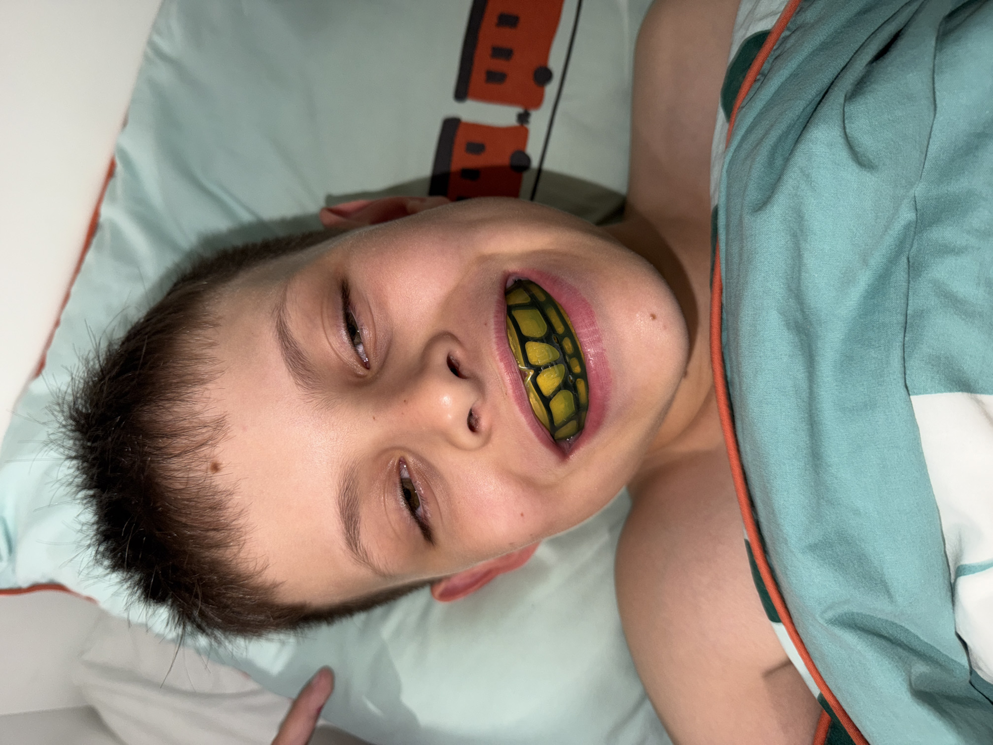 A young boy lies in bed, looking directly at the camera. He is wearing a yellow and black mouthguard that covers his teeth. The boy's eyes are partially closed, and he has a wide smile. He is lying on a pillow with a teal train pattern, and a teal blanket is pulled up to his chest. The background is a white wall and a corner of a white pillow. The image appears to have been taken indoors in a residential setting. There is no information provided about the location in Votkinsk, Russia.
