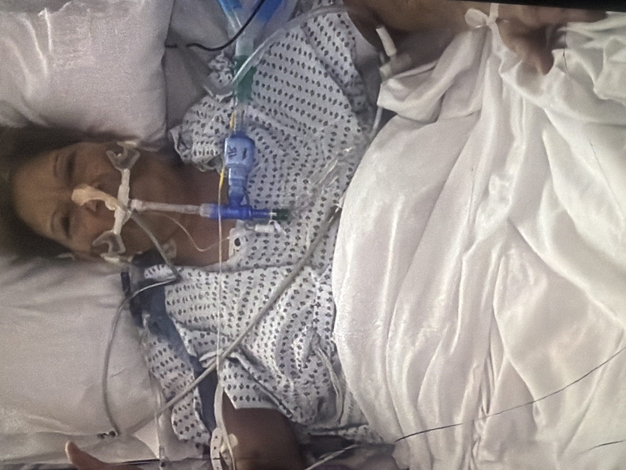 The image shows a person lying in a hospital bed, partially covered by a white blanket. The person is wearing a hospital gown and has medical tubes and wires attached to their face and body. The medical equipment includes a nasal cannula, a breathing tube connected to a blue and white adapter, and other tubes that are not clearly identifiable. The person's eyes are closed, and their head is tilted. The background consists of a white pillow and more bedding. The scene is consistent with a medical setting. There is no identifiable information in the image to suggest the location is Bukuru, Nigeria.