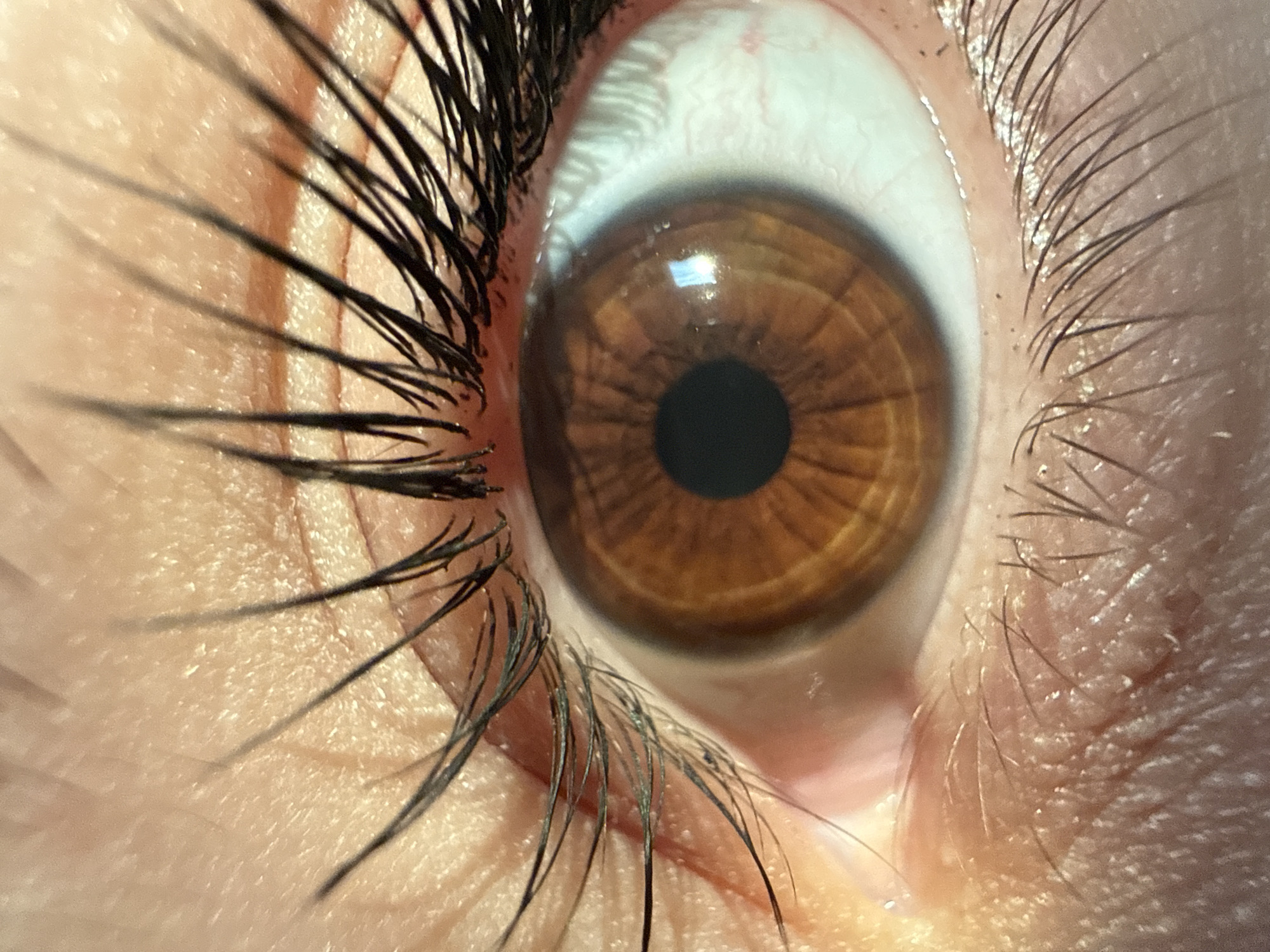A close-up macro photograph shows a human eye with a brown iris. The iris displays a radial pattern of lighter brown striations extending from the pupil outwards, with darker brown accents. The pupil is a solid black circle at the center. The sclera, or white part of the eye, is visible to the right, showing a network of fine blood vessels. The eyelid is covered in skin with visible pores and fine hairs. Several long, dark eyelashes frame the upper and lower parts of the eye, some appearing clumped together. A subtle highlight, reflecting a light source, is visible on the surface of the iris. The overall lighting suggests it is indoors, likely under artificial light. The image is focused on the details of the eye and surrounding skin, with no background elements or environmental context visible.