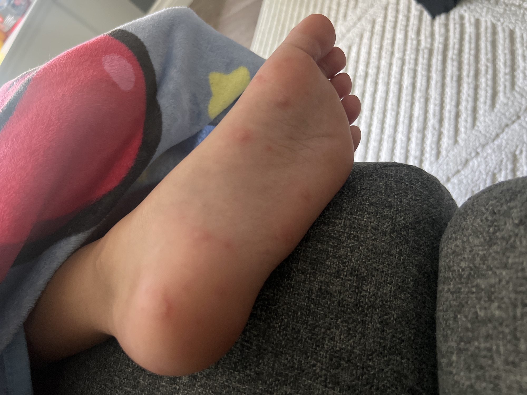 An overhead medium shot shows a child's bare left foot, with the sole facing upwards, resting on a dark grey textured fabric surface. The foot exhibits several small, reddish-pink spots scattered across the sole, primarily towards the arch and heel. The foot is partially covered by a soft, blue blanket featuring a pattern of large pink circular shapes and yellow star-like figures. The background consists of a white, ribbed textured surface. The scene appears to be indoors.