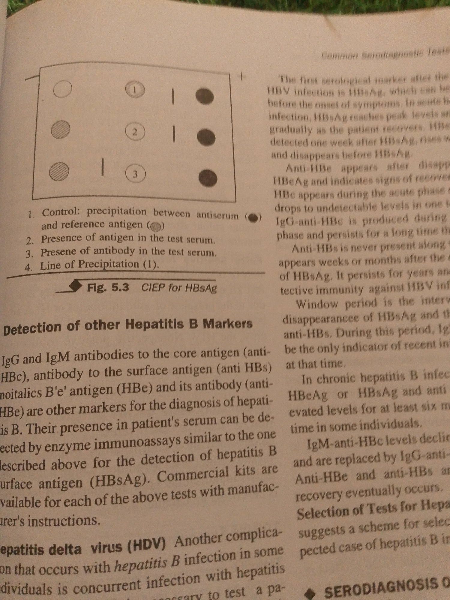 The image is a close-up, top-down photograph of an open textbook page. The page features printed text and a diagram illustrating a test result. The text discusses various markers related to Hepatitis B virus (HBV) infection, including HBsAg, HBeAg, anti-HBe, anti-HBc, and anti-HBs, along with their significance in diagnosis and recovery. It also briefly mentions Hepatitis Delta Virus (HDV) as a complication of Hepatitis B infection.
The diagram, labeled "Fig. 5.3 CIEP for HBsAg", shows a grid with circular and linear markings, suggesting precipitation lines. The numbered labels (1, 2, 3) and accompanying text describe the interpretation of these results, distinguishing between control, antigen presence, antibody presence, and precipitation lines.
The overall setting appears to be an indoor environment, likely a study area or classroom, given the nature of the content. The lighting is diffused, and there are no distinct cues about the time of day or weather. The focus is entirely on the printed material, with no people or prominent objects other than the book itself. The image is slightly blurred, suggesting it might be a photograph taken with a handheld camera. The text includes technical medical terminology related to serodiagnostic tests for Hepatitis B.
