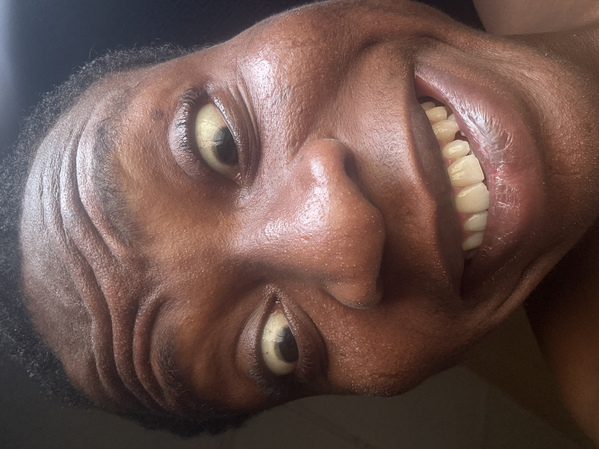 An extreme close-up, portrait-style shot captures the face of a person with dark skin and short, dark curly hair, tilted significantly (approximately 90 degrees clockwise) and looking directly at the viewer. The person is expressing a very wide, open-mouthed smile or grin, revealing many teeth that appear a natural yellowish-white color. The eyes are wide open, with prominent, distinctly yellowish sclera (whites of the eyes) and dark irises. Deep wrinkles are visible across the forehead and around the eyes, accentuated by the broad expression and the angle of the head. The skin appears somewhat shiny, with visible pores and texture. The background is dark and indistinct, focusing all attention on the face. No objects or text are visible in the image. The lighting is strong, highlighting facial contours and skin texture.