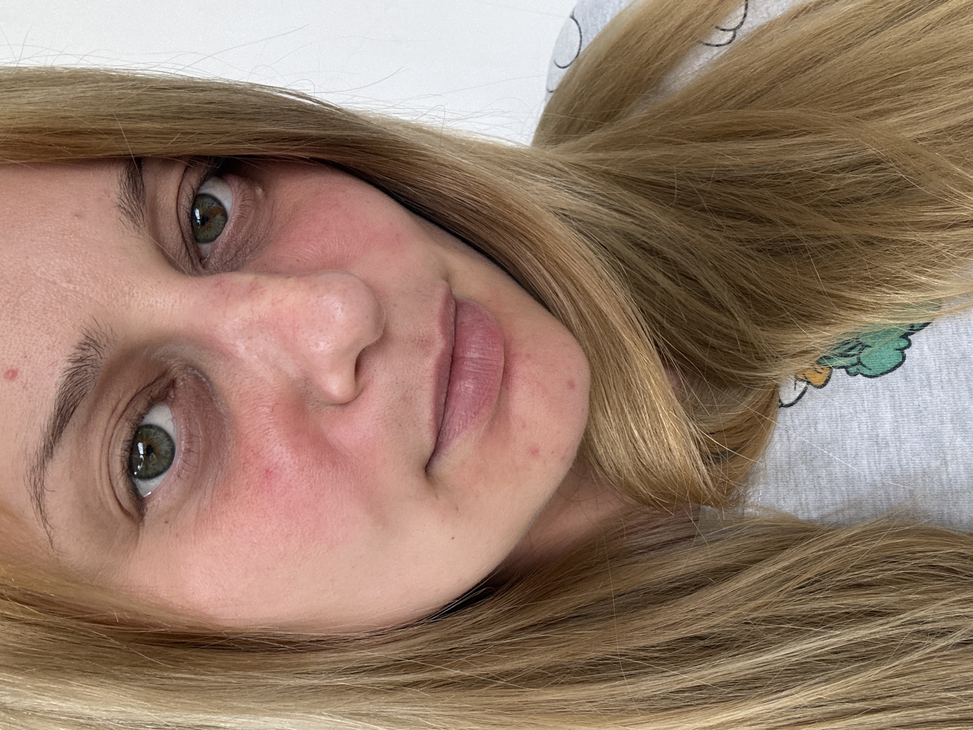 A fair-skinned woman with green eyes and blonde hair is pictured in a close-up, slightly angled portrait. Her face exhibits some redness and minor blemishes. She is wearing a light gray top with a cartoon graphic on the shoulder. The background is plain and white. The image does not contain enough information to determine if the location is Hazlemere, United Kingdom.