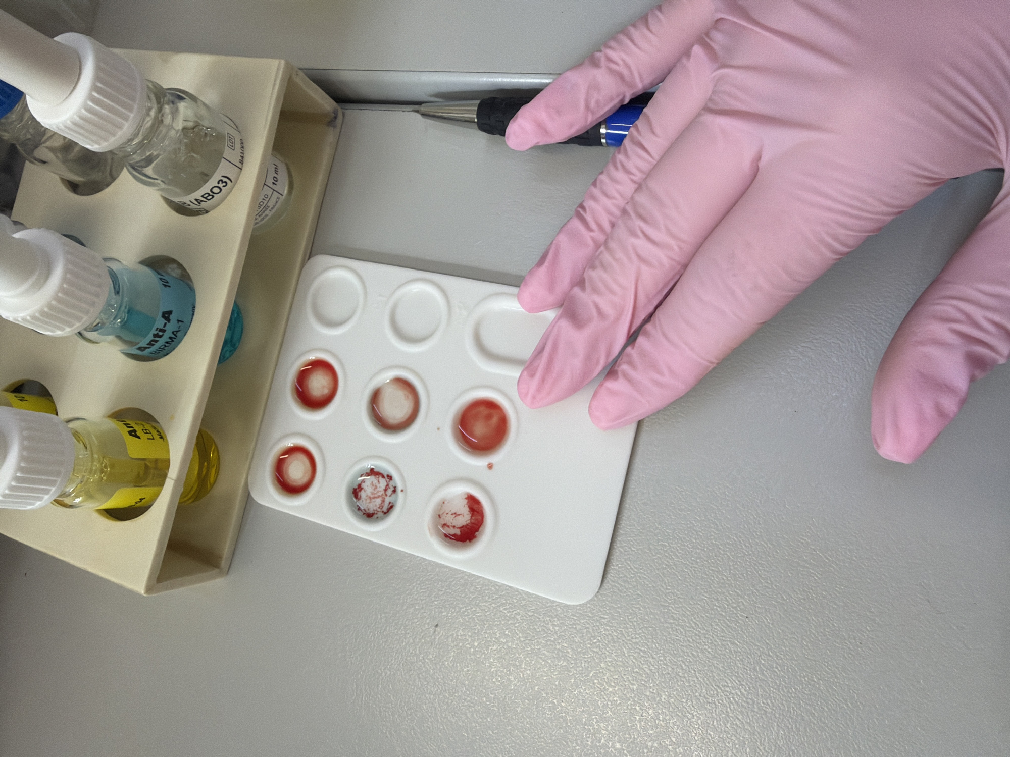 This media file presents a close-up view of a laboratory setting in Sofia, Bulgaria, focusing on a blood typing procedure. The central subject is a gloved right hand, covered in a pink disposable glove, positioned over a white rectangular plastic testing plate. This plate contains twelve circular wells, many of which hold red liquid, indicative of blood samples and reagents. Several wells show visible signs of agglutination (clumping), which is crucial for blood group determination.
To the left, a beige rack holds various small glass bottles, which are reagents used in the test. One bottle features a light blue label clearly displaying "Anti-A BIRMA-1" and "10 ml," indicating it contains anti-A antibodies. Another bottle is labeled "(ABO3)," "LOT 841000," and "10 ml," suggesting it is also an ABO blood group reagent. A yellow-labeled bottle, partially visible, has text like "Anti," "LB-," and "Ma." In the upper background, a pen with a blue and black grip is partially visible. All items rest on a light grey, textured laboratory countertop. The image conveys the controlled environment and detailed nature of medical diagnostic testing.