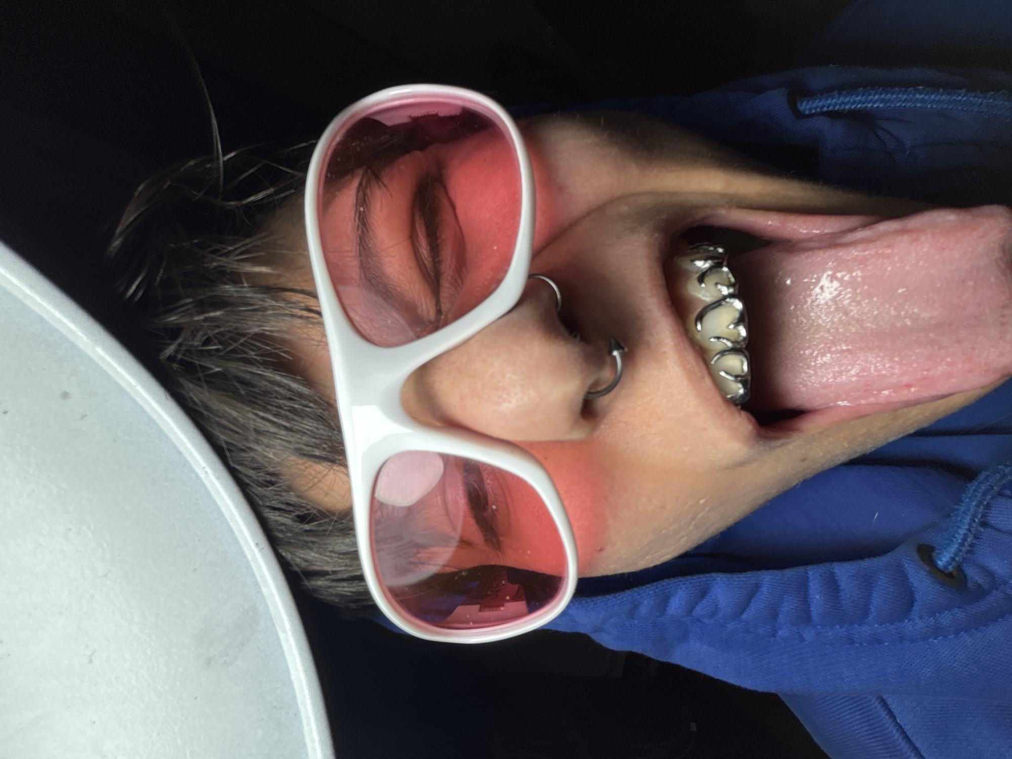 A person is lying in a dental chair wearing white sunglasses with pink lenses, which obscure their eyes. The person has two visible nose piercings. The person’s mouth is open, exposing dental crowns on their molars and their extended tongue. The person is wearing a blue hoodie. A dental light is partially visible. The location is unknown.