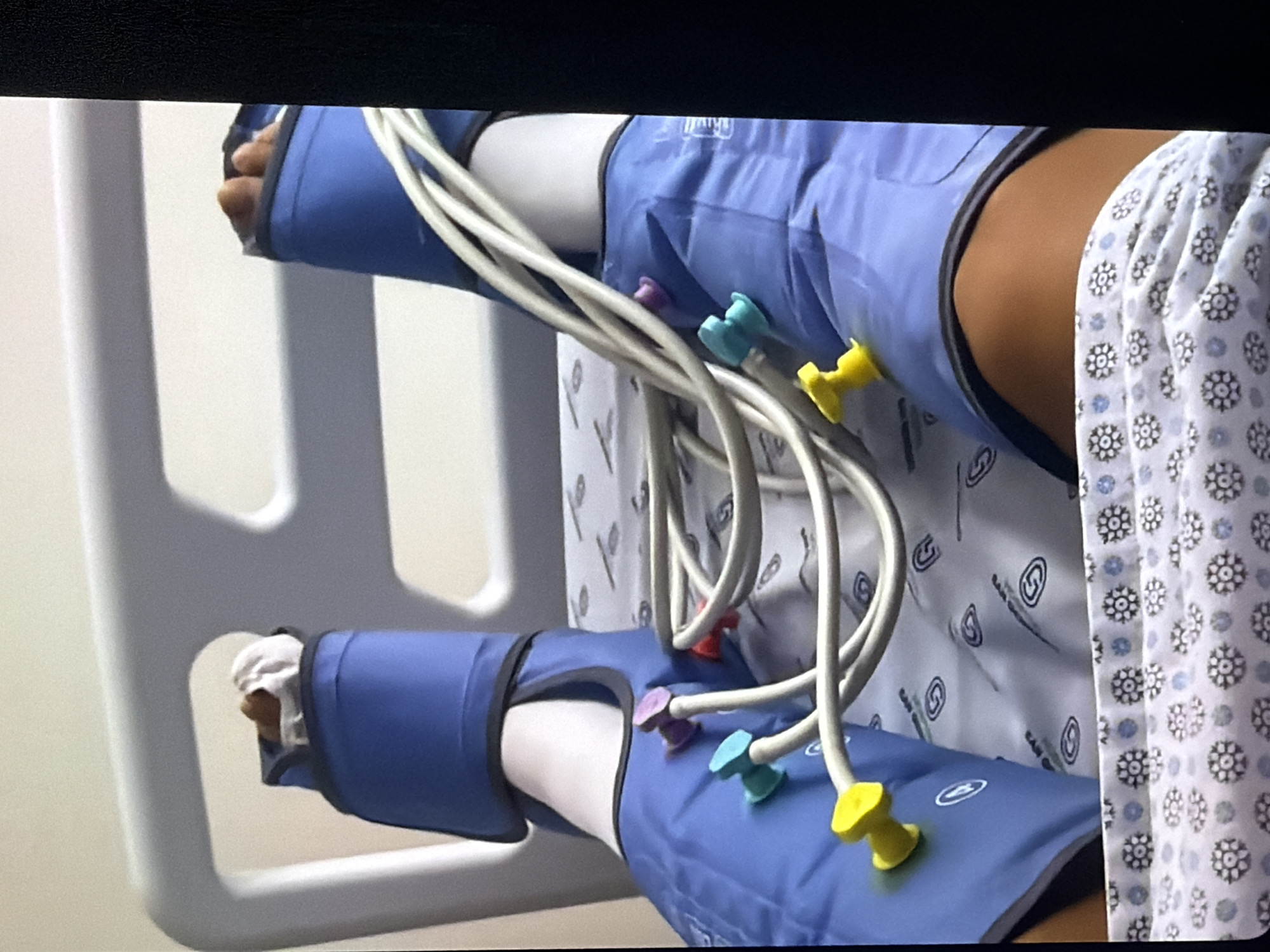 The image shows a person's legs from the knees down, lying in a hospital bed. The person is wearing blue compression sleeves on both legs, which are connected by white tubes to a medical device not visible in the frame. The tubes have various colored connectors (yellow, turquoise, purple, red). The hospital bed has white railings and is covered with a patterned sheet. The location is stated to be Bukuru, Nigeria.