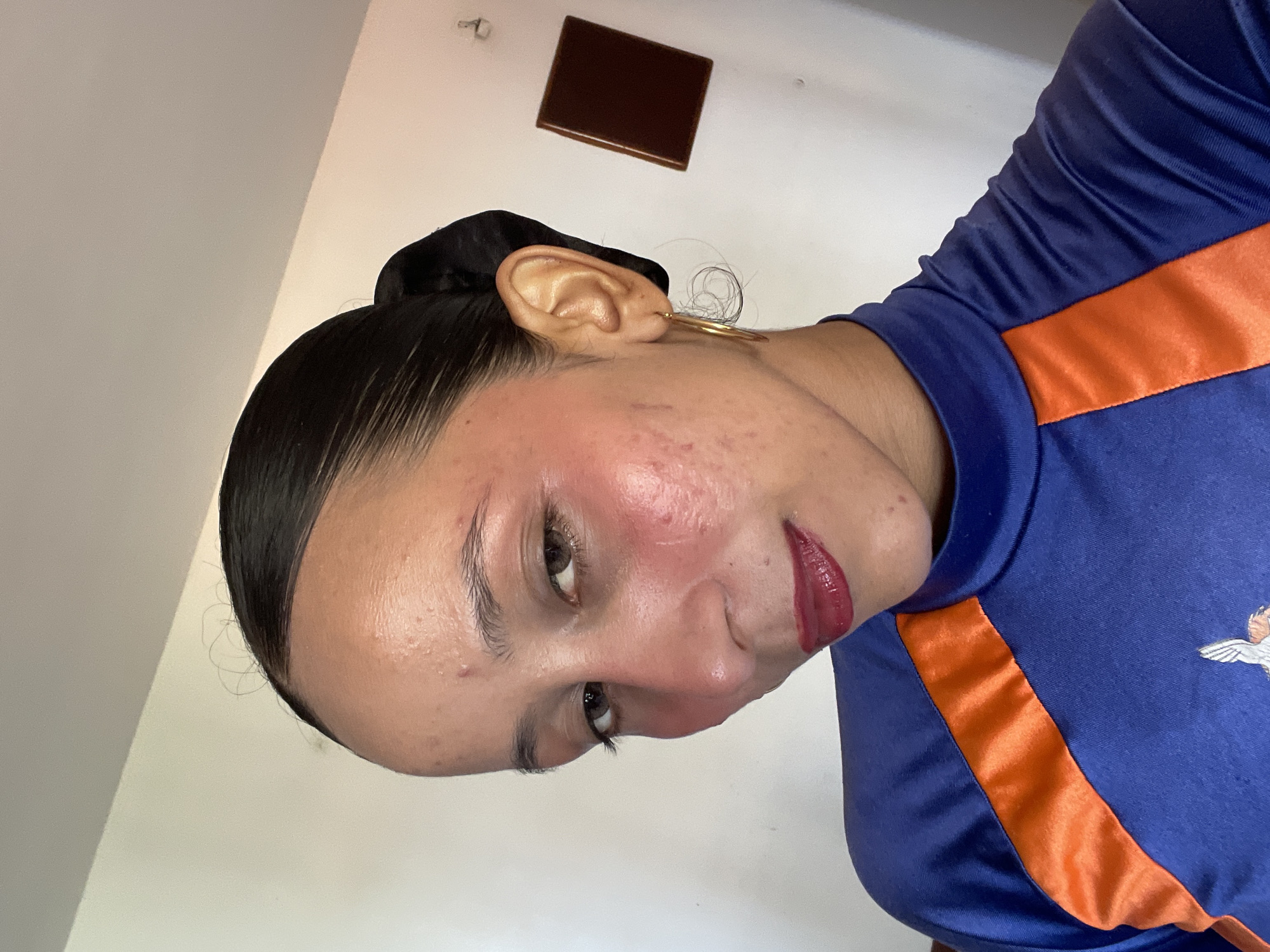 A young woman with dark hair pulled back and a blue and orange shirt poses for a selfie. She is looking slightly to the left of the camera. She is wearing gold hoop earrings and dark red lipstick. Her skin has visible blemishes and redness on her cheeks. The background is a plain, light-colored wall with a small, dark brown square object mounted on it. The image appears to be taken indoors, in what could be a domestic setting.