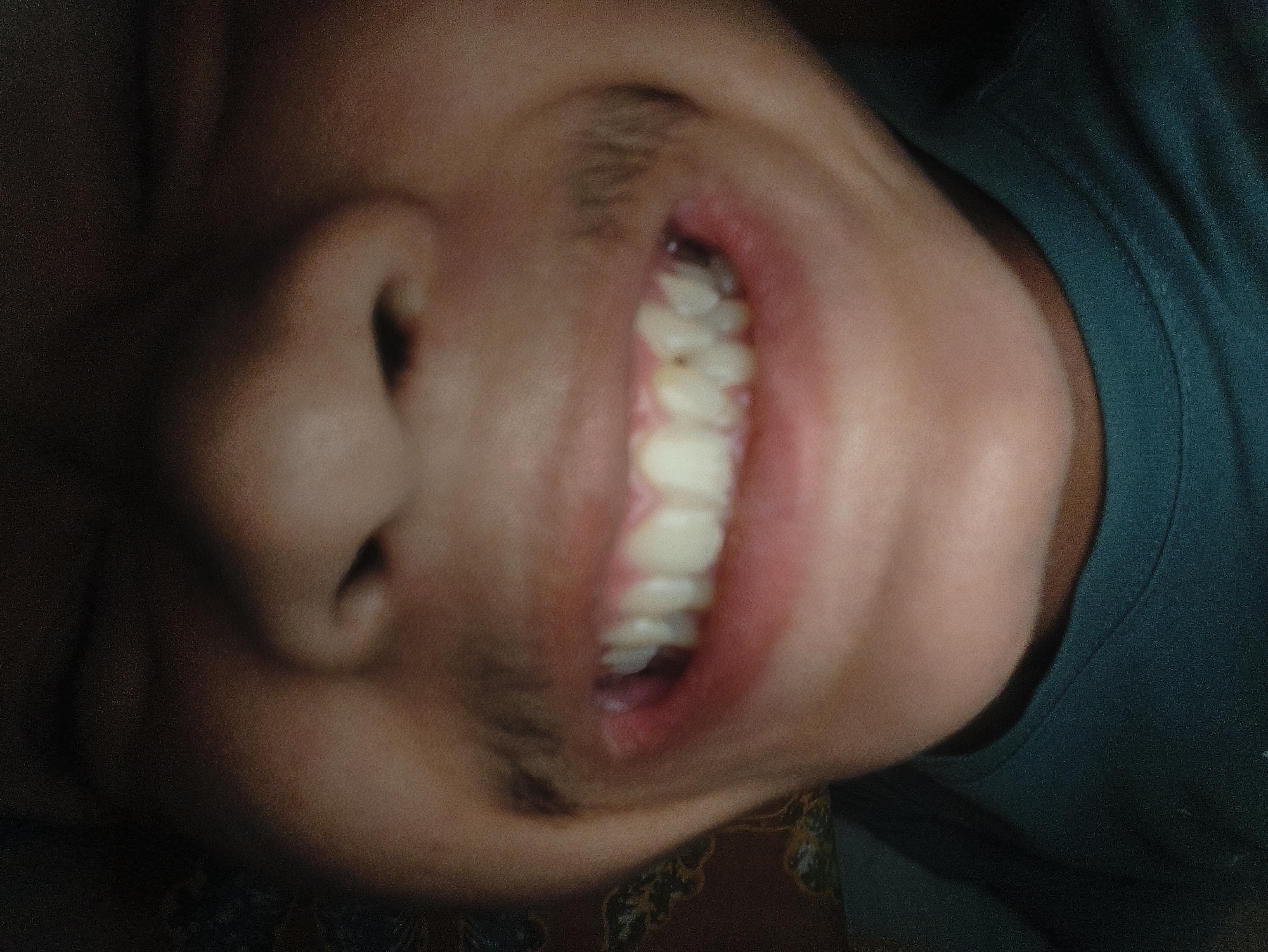 A close-up, rotated image depicts the lower portion of an individual's face, oriented with the top of the head to the left. The subject, exhibiting light to medium brown skin, is smiling, revealing an array of upper and lower teeth. Multiple upper teeth appear discolored or stained, with a distinct dark spot or cavity visible on an upper left premolar or canine. The gums are pink. Short facial hair, consistent with stubble or a mustache, is visible above the upper lip and extending onto the cheek/chin area. The subject is wearing a dark teal or dark green crew-neck garment, visible on the right side of the frame. A brown fabric with a dark, indistinct pattern is visible in the bottom-left background. The scene is located in Lhokseumawe, Indonesia.